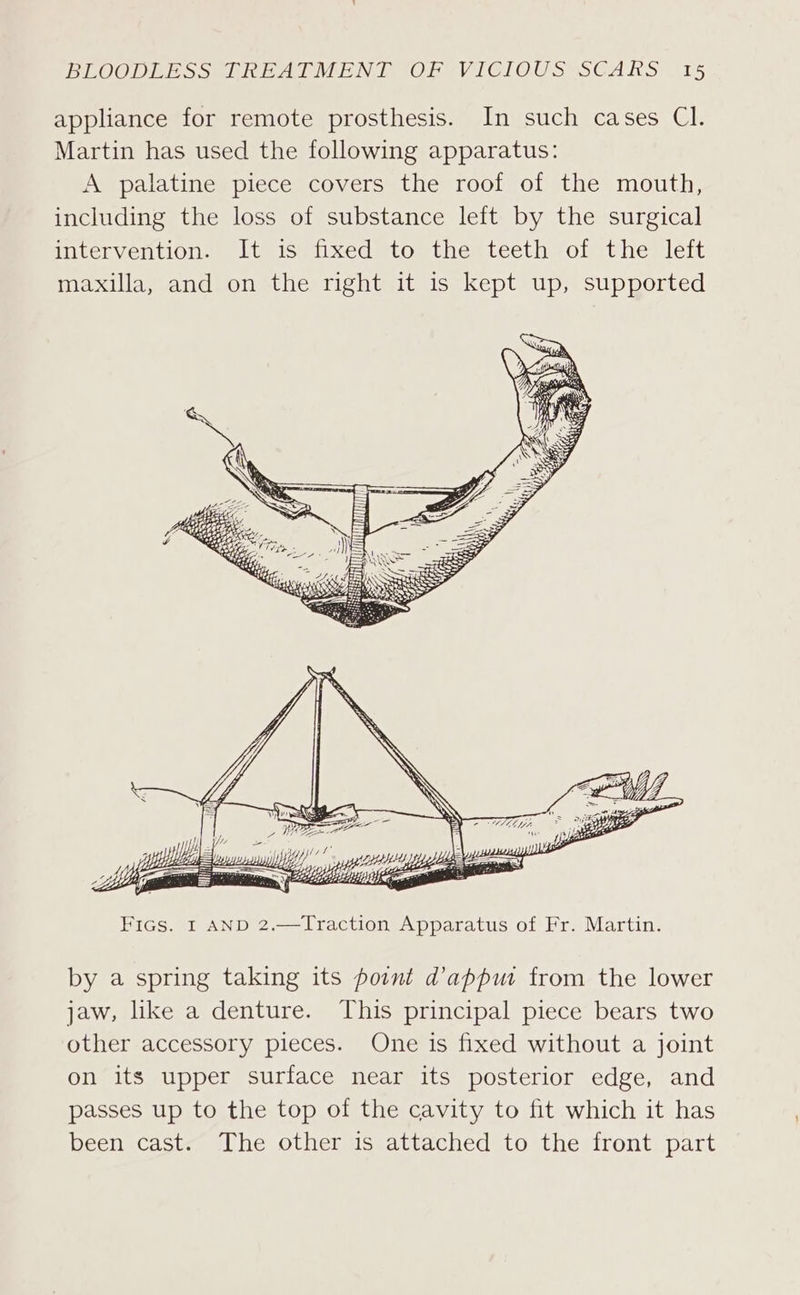 appliance for remote prosthesis. In such cases Cl. Martin has used the following apparatus: A palatine piece covers the roof of the mouth, including the loss of substance left by the surgical intervention. It) is; fixed to; the teeth oi the lett maxilla, and on the right it is kept up, supported by a spring taking its point d’appwu from the lower jaw, like a denture. This principal piece bears two other accessory pieces. One is fixed without a joint on its upper surface near its posterior edge, and passes up to the top of the cavity to fit which it has been cast. The other is attached to the front part