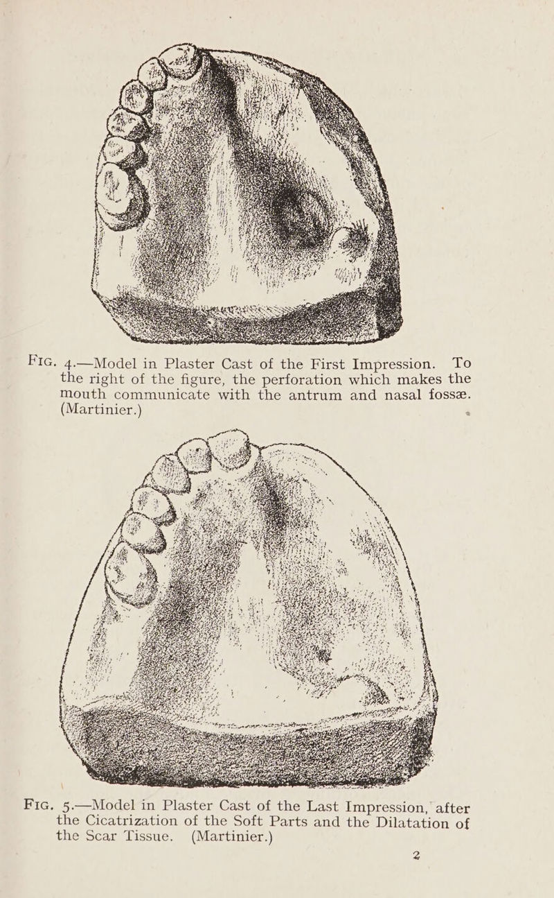 FIG. 4.—Model in Plaster Cast of the First Impression. To the right of the figure, the perforation which makes the mouth communicate with the antrum and nasal fosse. (Martinier.) ‘ ae et ate eer Arad fs ie nerd Fic. 5.—Model in Plaster Cast of the Last Impression, after the Cicatrization of the Soft Parts and the Dilatation of the Scar Tissue. (Martinier.)