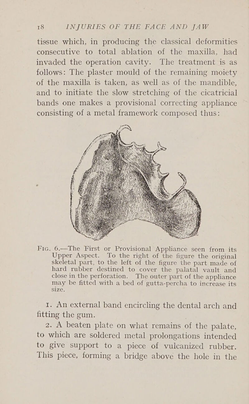 tissue which, in producing the classical deformities consecutive to total ablation of the maxilla, had invaded the operation cavity. The treatment is as follows: The plaster mould of the remaining moiety of the maxilla is taken, as well as of the mandible, and to initiate the slow stretching of the cicatricial bands one makes a provisional correcting appliance consisting of a metal framework composed thus: Fic. 6.—The First or Provisional Appliance seen from its Upper Aspect. To the right of the figure the original skeletal part, to the left of the figure the part made of hard rubber destined to cover the palatal vault and close in the perforation. The outer part of the appliance may be fitted with a bed of gutta-percha to increase its Size, 1. An external band encircling the dental arch and fitting the gum. 2. A beaten plate on what remains of the palate, to which are soldered metal prolongations intended to give support to a piece of vulcanized rubber. This piece, forming a bridge above the hole in the