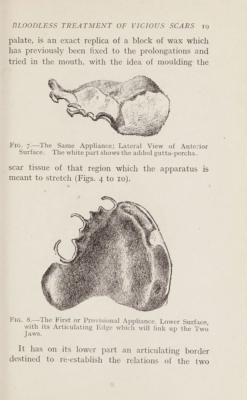 palate, is an exact replica of a block of wax which has previously been fixed to the prolongations and tried in the mouth, with the idea of moulding: the Fic. 7——-The Same Appliance: Lateral View of Antezior Surface. ‘The white part shows the added gutta-percha. scar tissue of that region which the apparatus is meant to stretch (Figs. 4 to Io). Fic. 8.—The First or Provisional Appliance, Lower Surface, with its Articulating Edge which will link up the Two Jaws. It has on its lower part an articulating border destined to re-establish the relations of the two