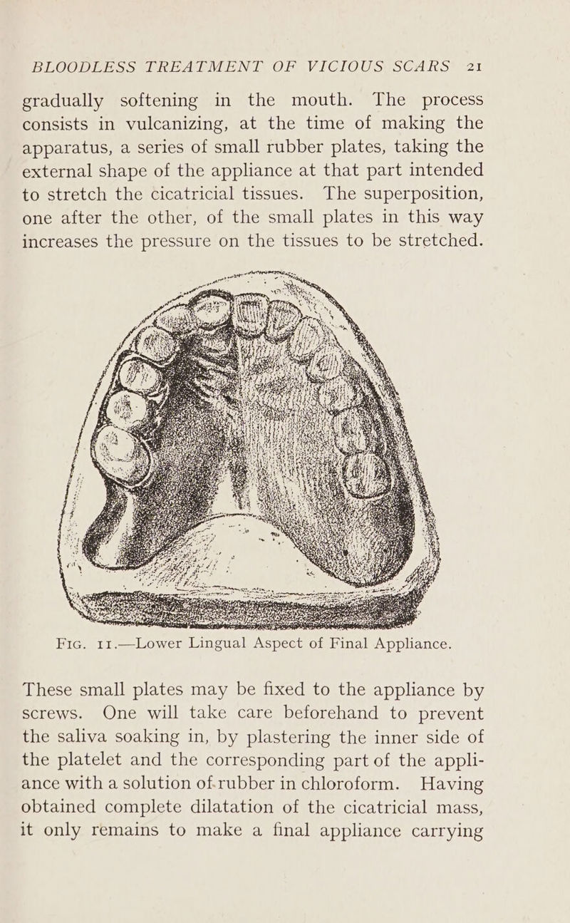 gradually softening in the mouth. The process consists in vulcanizing, at the time of making the apparatus, a series of small rubber plates, taking the external shape of the appliance at that part intended to stretch the cicatricial tissues. The superposition, one after the other, of the small plates in this way increases the pressure on the tissues to be stretched. DR reas arbre atid &lt;P Fic. 11.—Lower Lingual Aspect of Final Appliance. These small plates may be fixed to the appliance by screws. One will take care beforehand to prevent the saliva soaking in, by plastering the inner side of the platelet and the corresponding part of the appli- ance with a solution of.rubber in chloroform. Having obtained complete dilatation of the cicatricial mass, it only remains to make a final appliance carrying