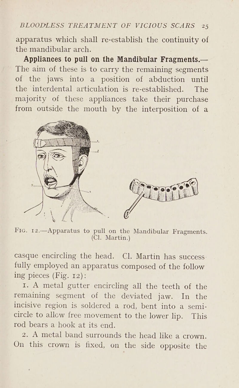 apparatus which shall re-establish the continuity of the mandibular arch. Appliances to pull on the Mandibular Fragments.— The aim of these is to carry the remaining segments of the jaws into a position of abduction until the interdental articulation is re-established. The majority of these appliances take their purchase from outside the mouth by the interposition of a Fic. 12.—Apparatus to pull on the Mandibular Fragments. (Cl. Martin.) casque encircling the head. Cl. Martin has success: fully employed an apparatus composed of the follow ing pieces (Fig. 12): 1. A metal gutter encircling all the teeth of the remaining segment of the deviated jaw. In the incisive region is soldered a rod, bent into a semi- circle to allow free movement to the lower lip. This rod bears a hook at its end. 2. A metal band surrounds the head like a crown. On this crown is fixed, on the side opposite the