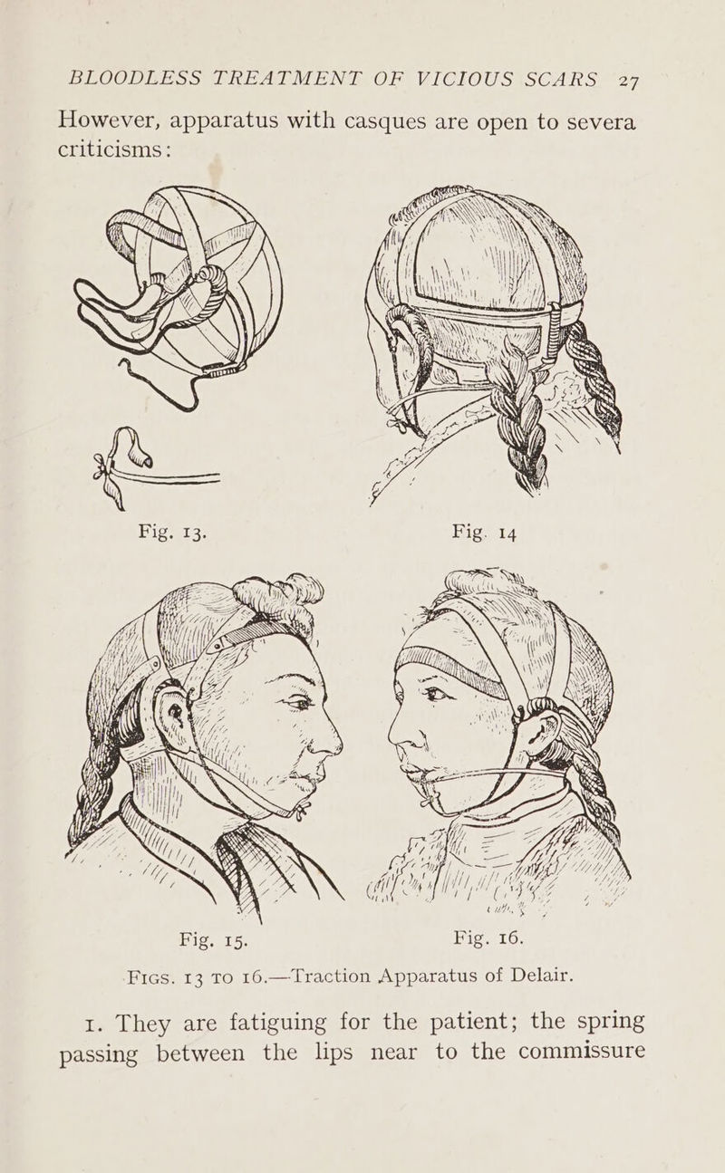 However, apparatus with casques are open to severa criticisms: 1. They are fatiguing for the patient; the spring passing between the lips near to the commissure