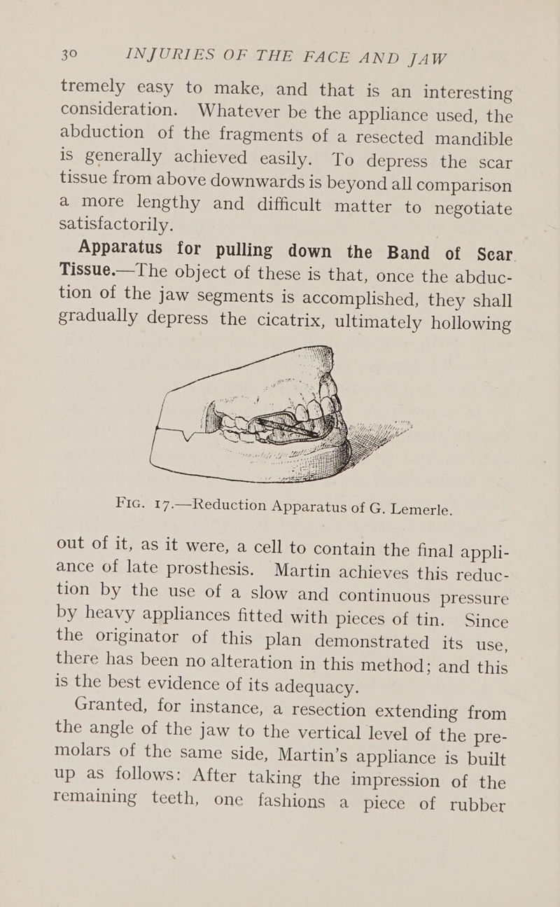 tremely easy to make, and that is an interesting consideration. Whatever be the appliance used, the abduction of the fragments of a resected mandible is generally achieved easily. To depress the scar tissue from above downwards is beyond all comparison a more lengthy and difficult matter to negotiate satisfactorily. Apparatus for pulling down the Band of Sear. Tissue.—The object of these is that, once the abduc- tion of the jaw segments is accomplished, they shall gradually depress the cicatrix, ultimately hollowing Fic. 17.—Reduction Apparatus of G. Lemerle. out of it, as it were, a cell to contain the final appli- ance of late prosthesis. Martin achieves this reduc- tion by the use of a slow and continuous pressure by heavy appliances fitted with pieces of tin. Since the originator of this plan demonstrated its use, there has been no alteration in this method; and this is the best evidence of its adequacy. Granted, for instance, a resection extending from the angle of the jaw to the vertical level of the pre- molars of the same side, Martin’s appliance is built up as follows: After taking the impression of the remaining teeth, one fashions a piece of rubber