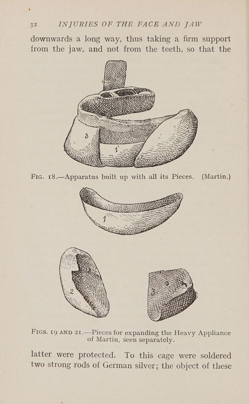 downwards a long way, thus taking a firm support from the jaw, and not from the teeth, so that the TN aga s gah) iP ash NY oe Kgbboeoleg see, eae EAE LLU Utd EH ae ‘ : SI aA PLS <x \ WWsss ag phiies 4g $) Soin aS 3 aN SSS ae y an Sai QUE SY y Be ARS RESTS med ANNANS ~ > a A Th ANYAANAAAAYARARRRRSRRRS SAVES = 4 p88 YASS = Z, 7) SWS =: Wo Yf; i rs é TM: A g iy) VK f RON SOSSS SSS SSS RES see SiN = (AAS BETA mG SSS Sh a SR SPN Fic. 18.—Apparatus built up with all its Pieces (Martin.) x 2 AA en Oe Sig Be SS , ee % 8 J 9, FIGS. 19 AND 21.—-Pieces for expanding the Heavy Appliance of Martin, seen separately. latter were protected. To this cage were soldered two strong rods of German silver; the object of these