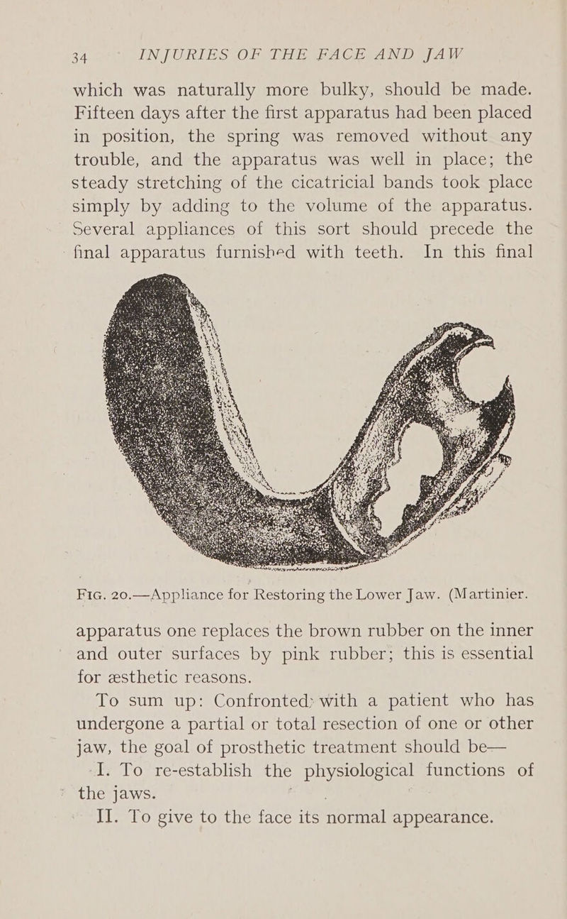 which was naturally more bulky, should be made. Fifteen days after the first apparatus had been placed in position, the spring was removed without any trouble, and the apparatus was well in place; the steady stretching of the cicatricial bands took place simply by adding to the volume of the apparatus. Several appliances of this sort should precede the final apparatus furnished with teeth. In this final Fic. 20.—Appliance for Restoring the Lower Jaw. (Martinier. apparatus one replaces the brown rubber on the inner and outer surfaces by pink rubber; this is essential for esthetic reasons. To sum up: Confronted: with a patient who has undergone a partial or total resection of one or other jaw, the goal of prosthetic treatment should be— “I. To re-establish the physiological functions of the jaws. Il. To give to the face its saan appearance.