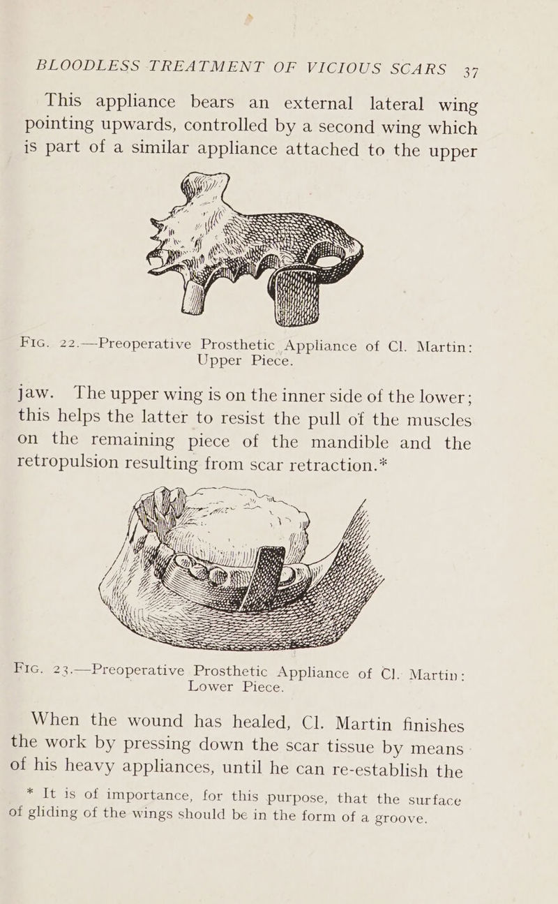 This appliance bears an external lateral wing pointing upwards, controlled by a second wing which is part of a similar appliance attached to the upper ies SSS SESS SS SO STALE HLS Se “ Fic. 22.—Preoperative Prosthetic Appliance of Cl. Martin: Upper Piece. jaw. The upper wing is on the inner side of the lower; this helps the latter to resist the pull of the muscles on the remaining piece of the mandible and the retropulsion resulting from scar retraction.* 5 ar OL os oa Fic. 23.—Preoperative Prosthetic Appliance of Cl. Martin: Lower Piece. When the wound has healed, Cl. Martin finishes the work by pressing down the scar tissue by means of his heavy appliances, until he can re-establish the * It is of importance, for this purpose, that the surface of gliding of the wings should be in the form of a groove.