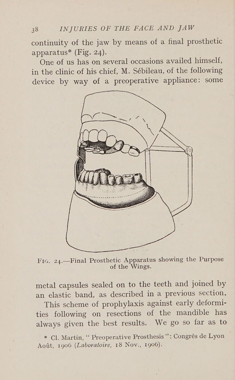 continuity of the jaw by means of a final prosthetic apparatus* (Fig. 24). One of us has on several occasions availed himself, in the clinic of his chief, M. Sébileau, of the following device by way of a preoperative appliance: some Fic, 24.—Final Prosthetic Apparatus showing the Purpose of the Wings. metal capsules sealed on to the teeth and joined by an elastic band, as described in a previous section. This scheme of prophylaxis against early deformi- ties following on resections of the mandible has always given the best results. We go so far as to * Cl Martin, ~ Preoperative Prosthesis’: Congrés de Lyon Aott, 1906 (Laboratoire, 18 Nov., 1906).