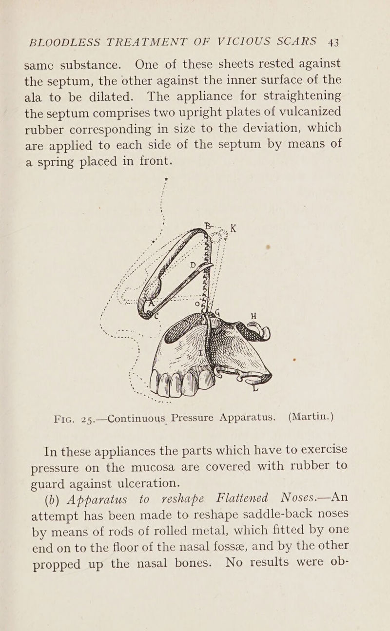 same substance. One of these sheets rested against the septum, the other against the inner surface of the ala to be dilated. The appliance for straightening the septum comprises two upright plates of vulcanized rubber corresponding in size to the deviation, which are applied to each side of the septum by means of a spring placed in front. Serene Fic. 25.—Continuous Pressure Apparatus. (Martin.) In these appliances the parts which have to exercise pressure on the mucosa are covered with rubber to guard against ulceration. (b) Apparatus to reshape Flattened Noses.—An attempt has been made to reshape saddle-back noses by means of rods of rolled metal, which fitted by one end on to the floor of the nasal fossz, and by the other propped up the nasal bones. No results were ob-