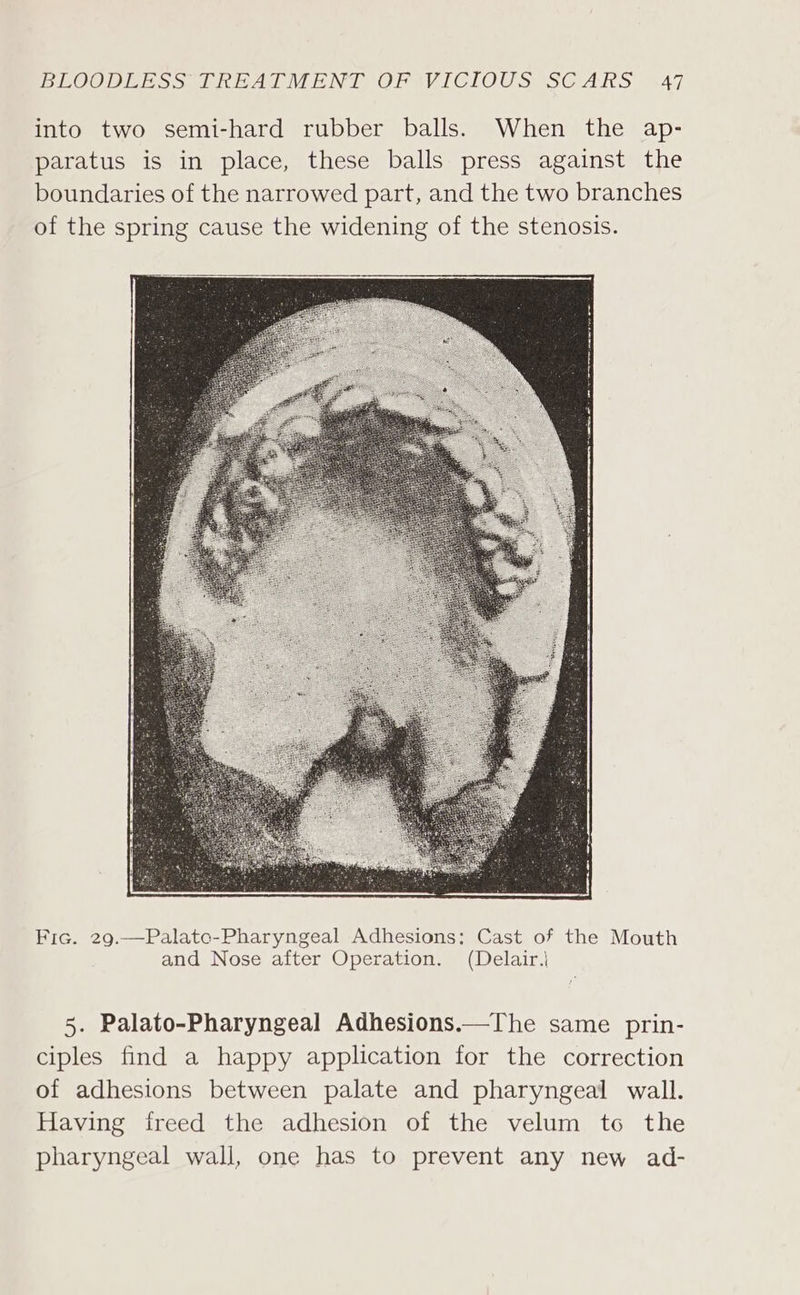 into two semi-hard rubber balls. When the ap- paratus is in place, these balls press against the boundaries of the narrowed part, and the two branches of the spring cause the widening of the stenosis. Fic. 29.—Palatc-Pharyngeal Adhesions: Cast of the Mouth and Nose after Operation. (Delair.| 5. Palato-Pharyngeal Adhesions.—The same prin- ciples find a happy application for the correction of adhesions between palate and pharyngeal wall. Having freed the adhesion of the velum to the pharyngeal wall, one has to prevent any new ad-