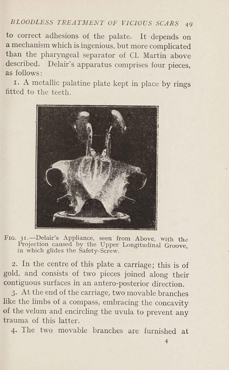 to correct adhesions of the palate. It depends on a mechanism which is ingenious, but more complicated than the pharyngeal separator of Cl. Martin above described. Delair’s apparatus comprises four pieces, as ape . A metallic palatine plate kept in ae by rings ae to the teeth. Fic. 31.—Delair’s Appliance, seen from Above, with the Projection caused by the Upper Longitudinal Groove, in which glides the Safety-Screw. 2. In the centre of this plate a carriage; this is of gold, and consists of two pieces joined along their contiguous surfaces in an antero-posterior direction. 3. At the end of the carriage, two movable branches like the limbs of a compass, embracing the concavity of the velum and encircling the uvula to prevent any trauma of this latter. 4. The two movable branches are furnished at 4