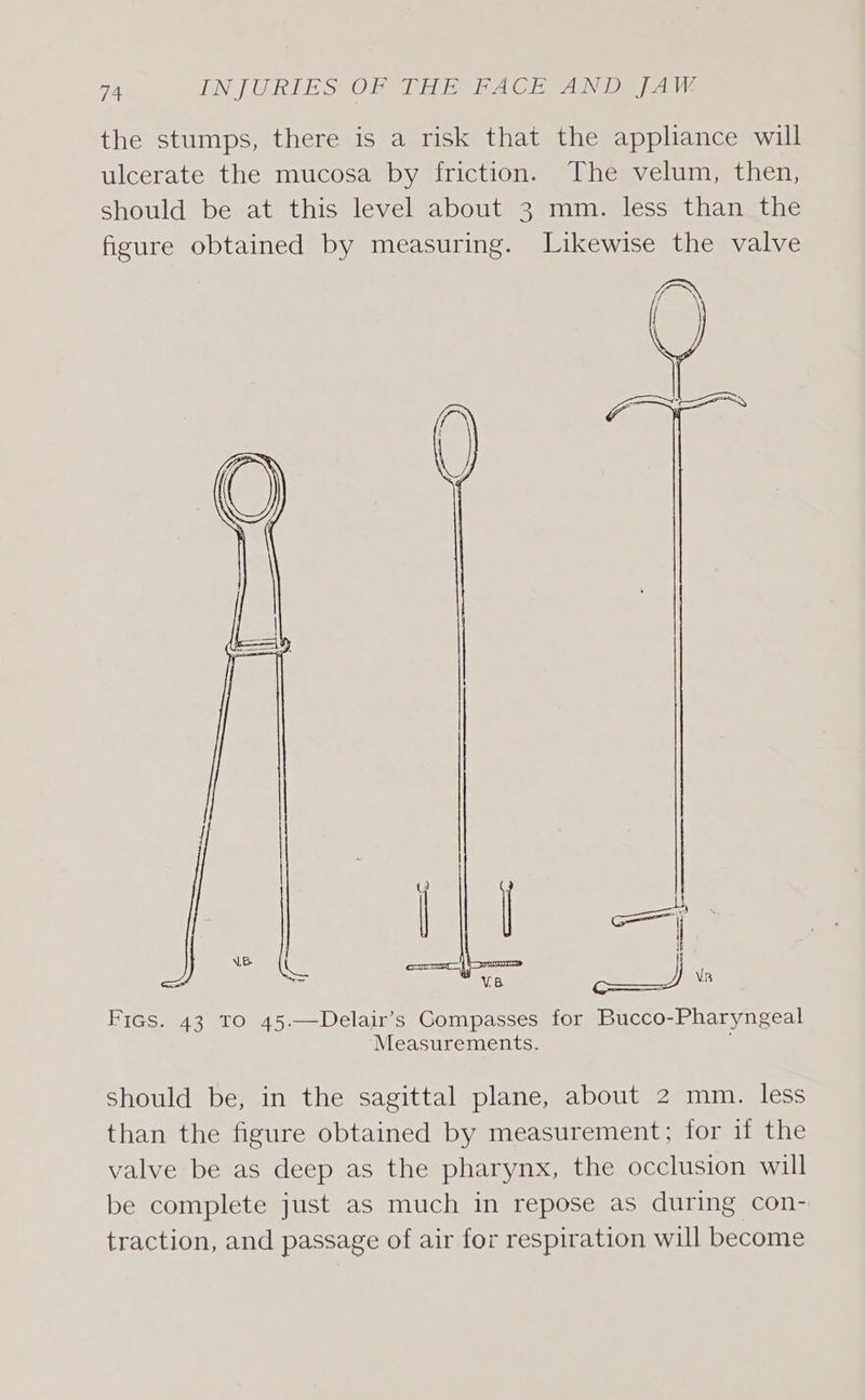 the stumps, there is a risk that the appliance will ulcerate the mucosa by friction. The velum, then, should be at this level about 3 mm. less than the figure obtained by measuring. Likewise the valve Figs. 43 TO 45.—Delair’s Compasses for Bucco-Pharyngeal Measurements. should be, in the sagittal plane, about 2 mm. less than the figure obtained by measurement; for if the valve be as deep as the pharynx, the occlusion will be complete just as much in repose as during con- traction, and passage of air for respiration will become