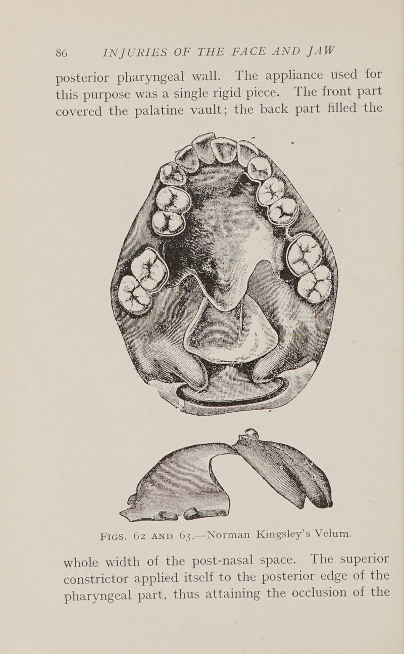 posterior pharyngeal wall. The appliance used for this purpose was a single rigid piece. The front part covered the palatine vault; the back part filled the Norman Kingsley’s Velum. HIGS.902)4ND 63, whole width of the post-nasal space. The superior constrictor applied itself to the posterior edge of the pharyngeal part, thus attaining the occlusion of the