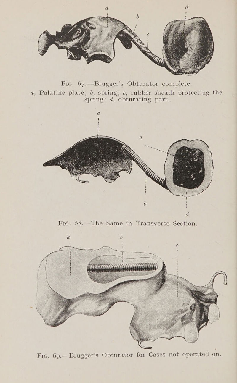 Fic. 67.—Brugger’s Obturator complete. a, Palatine plate; 6, spring; c, rubber sheath protecting the spring; d, obturating part. a i ' BiG. v6s2—l he=samenin