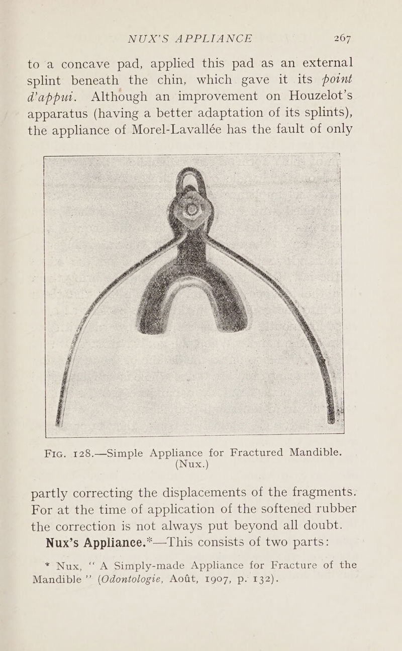 to a concave pad, applied this pad as an external splint beneath the chin, which gave it its point d’appui. Although an improvement on Houzelot’s apparatus (having a better adaptation of its splints), the appliance of Morel-Lavallée has the fault of only Fic. 128.—Simple Appliance for Fractured Mandible. (Nux.) partly correcting the displacements of the fragments. For at the time of application of the softened rubber the correction is not always put beyond all doubt. Nux’s Appliance.*—This consists of two parts: * Nux, “ A Simply-made Appliance for Fracture of the Mandible ”’ (Odontologie, Aofit, 1907, p. 132).