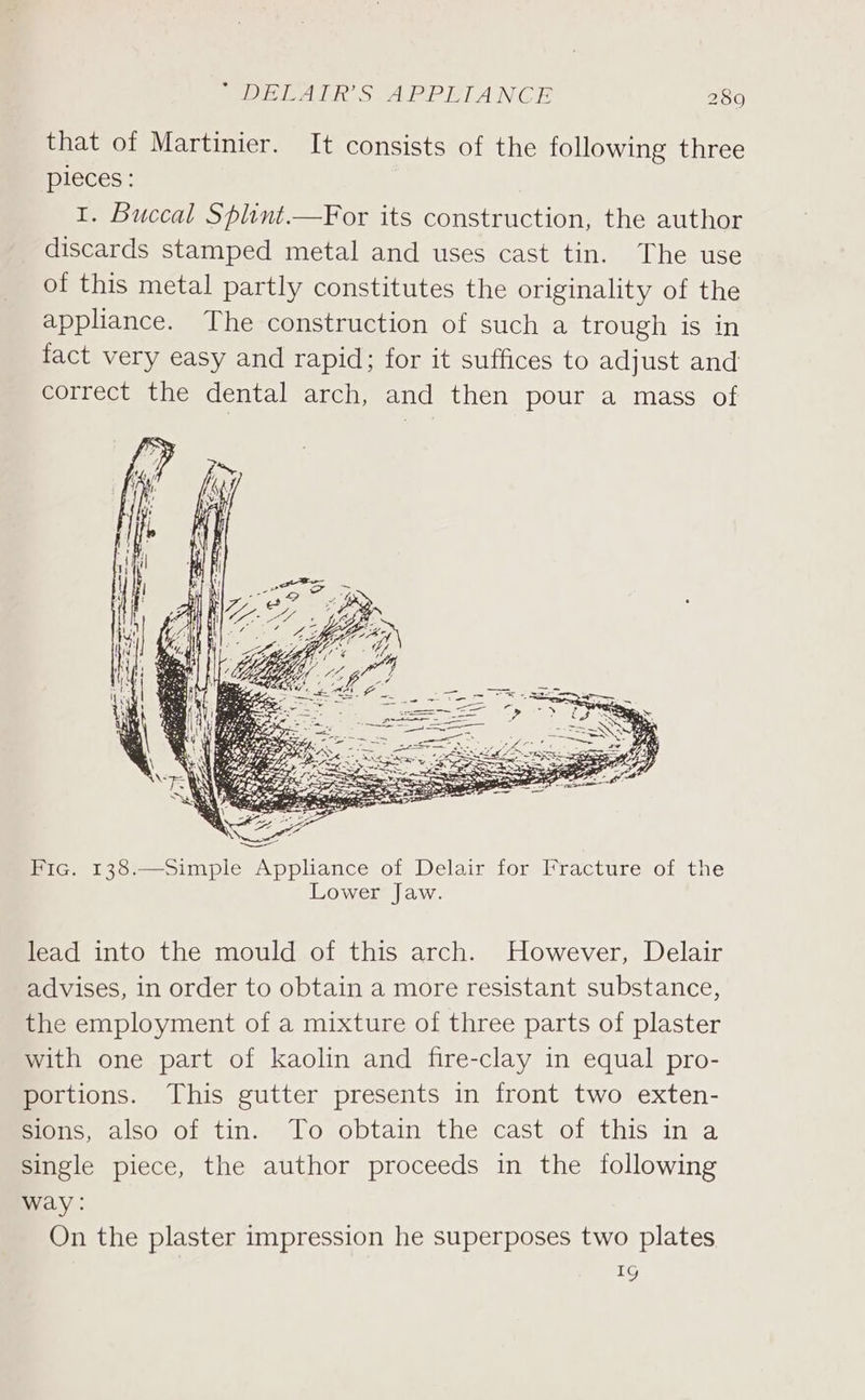 that of Martinier. It consists of the following three pieces: 1. Buccal Splint.—For its construction, the author discards stamped metal and uses cast tin. The use of this metal partly constitutes the originality of the appliance. The construction of such a trough is in fact very easy and rapid; for it suffices to adjust and correct the dental arch, and then pour a mass of Fic. 138.—Simple Appliance of Delair for Fracture of the Lower Jaw. lead into the mould of this arch. However, Delair advises, in order to obtain a more resistant substance, the employment of a mixture of three parts of plaster with one part of kaolin and fire-clay in equal pro- portions. This gutter presents in front two exten- mons also of-tin. To obtain the cast of this in’ a single piece, the author proceeds in the following way: On the plaster impression he superposes two plates IG