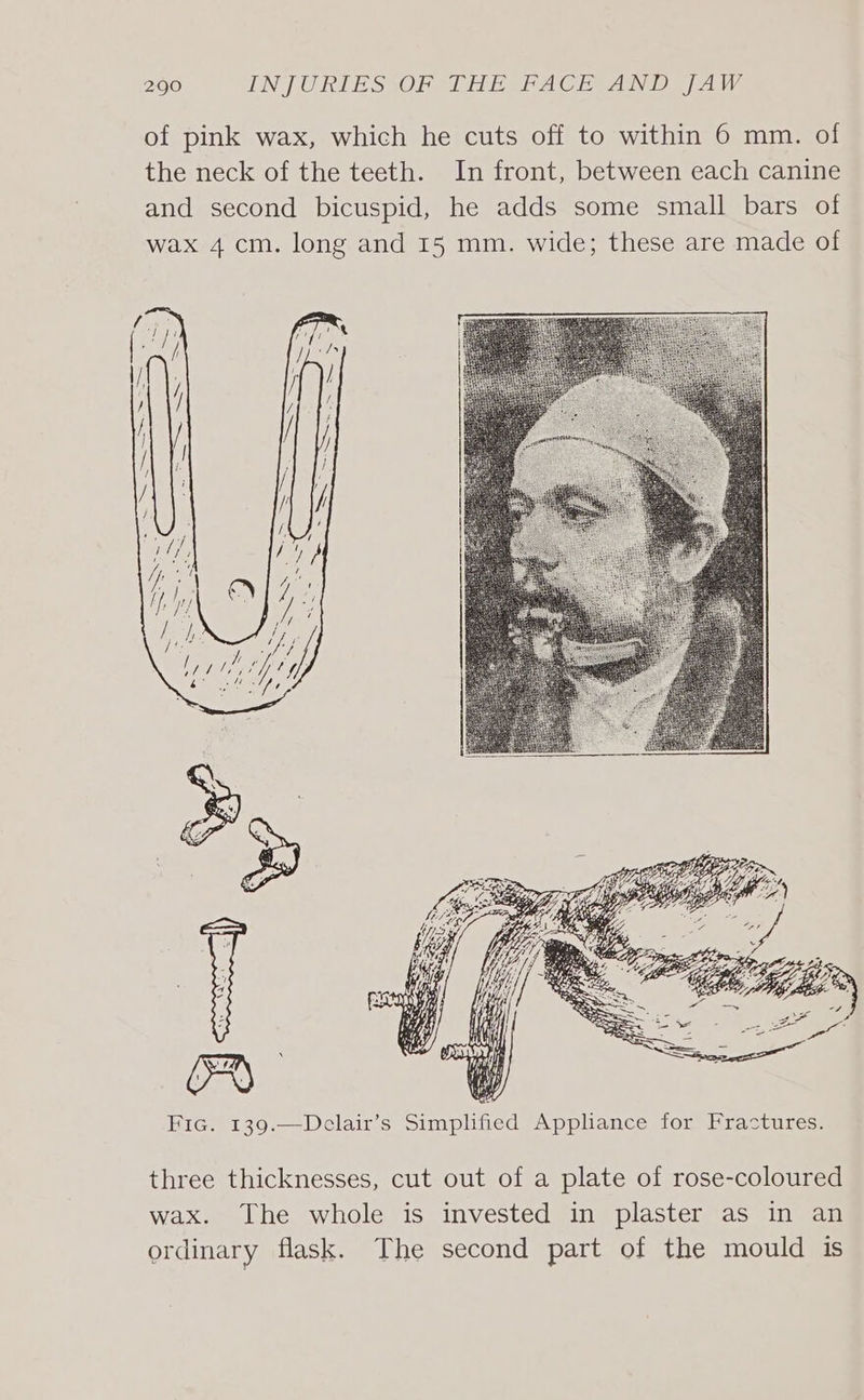 of pink wax, which he cuts off to within 6 mm. of the neck of the teeth. In front, between each canine and second bicuspid, he adds some small bars of wax 4 cm. long and 15 mm. wide; these are made of three thicknesses, cut out of a plate of rose-coloured wax. The whole is invested in plaster as in an ordinary flask. The second part of the mould is