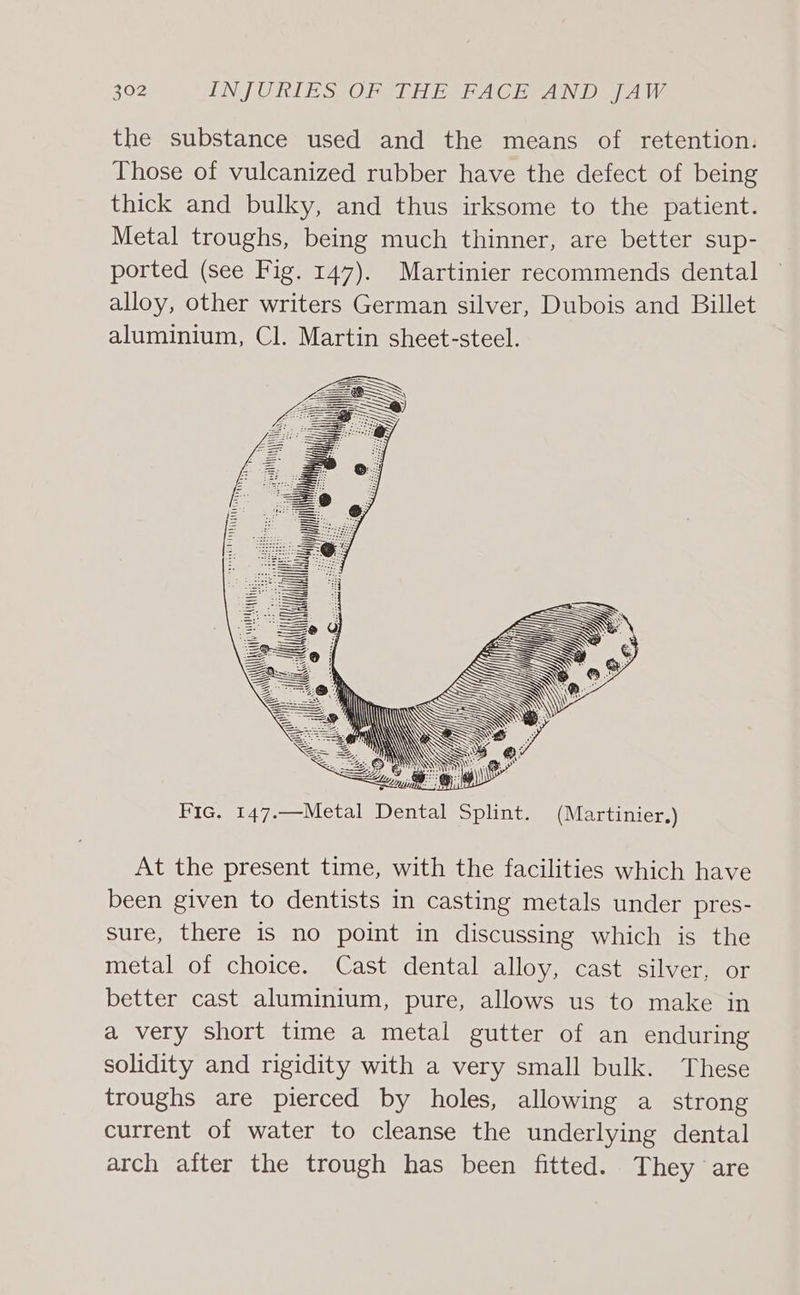 the substance used and the means of retention. Those of vulcanized rubber have the defect of being thick and bulky, and thus irksome to the patient. Metal troughs, being much thinner, are better sup- ported (see Fig. 147). Martinier recommends dental alloy, other writers German silver, Dubois and Billet aluminium, Cl. Martin sheet-steel. Fic. 147.—Metal Dental Splint. (Martinier.) At the present time, with the facilities which have been given to dentists in casting metals under pres- sure, there is no point in discussing which is the metal of choice. Cast dental alloy, cast silver, or better cast aluminium, pure, allows us to make in a very short time a metal gutter of an enduring solidity and rigidity with a very small bulk. These troughs are pierced by holes, allowing a strong current of water to cleanse the underlying dental arch after the trough has been fitted. They are