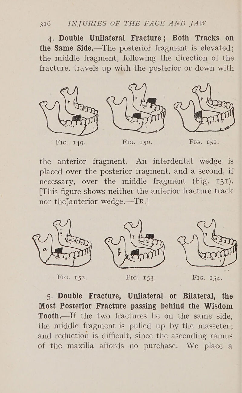 310 INJURIES TO RMA EEA CE AND (AW 4. Double Unilateral Fracture; Both Tracks on the Same Side.—The posterior fragment is elevated; the middle fragment, following the direction of the fracture, travels up with the posterior or down with Fic. 149. FIG. 150. HIG) T5is the anterior fragment. An interdental wedge is placed over the posterior fragment, and a second, if necessary, over the middle fragment (Fig. 151). [This figure shows neither the anterior fracture track nor the;anterior wedge.—TR. HiGier52: Fic. 153. FIG. 154. 5. Double Fracture, Unilateral or Bilateral, the Most Posterior Fracture passing behind the Wisdom Tooth.—If the two fractures lie on the same side, the middle fragment is pulled up by the masseter; and reduction is difficult, since the ascending ramus of the maxilla affords no purchase. We place a