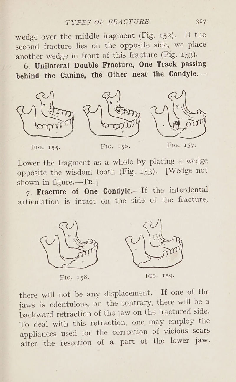 wedge over the middle fragment (Fig. 52) eel hie second fracture lies on the opposite side, we place another wedge in front of this fracture (Fig. 153). 6. Unilateral Double Fracture, One Track passing behind the Canine, the Other near the Condyle.— Fic. 155. Fic. 156. PIGweL 57. Lower the fragment as a whole by placing a wedge opposite the wisdom tooth (Fig. 153). [Wedge not shown in figure.—TR.] 7. Fracture of One Condyle.—Ii the interdental articulation is intact on the side of the fracture, there will not be any displacement. If one of the jaws is edentulous, on the contrary, there will be a backward retraction of the jaw on the fractured side. To deal with this retraction, one may employ the appliances used for the correction of vicious scars after the resection of a part of the lower jaw.