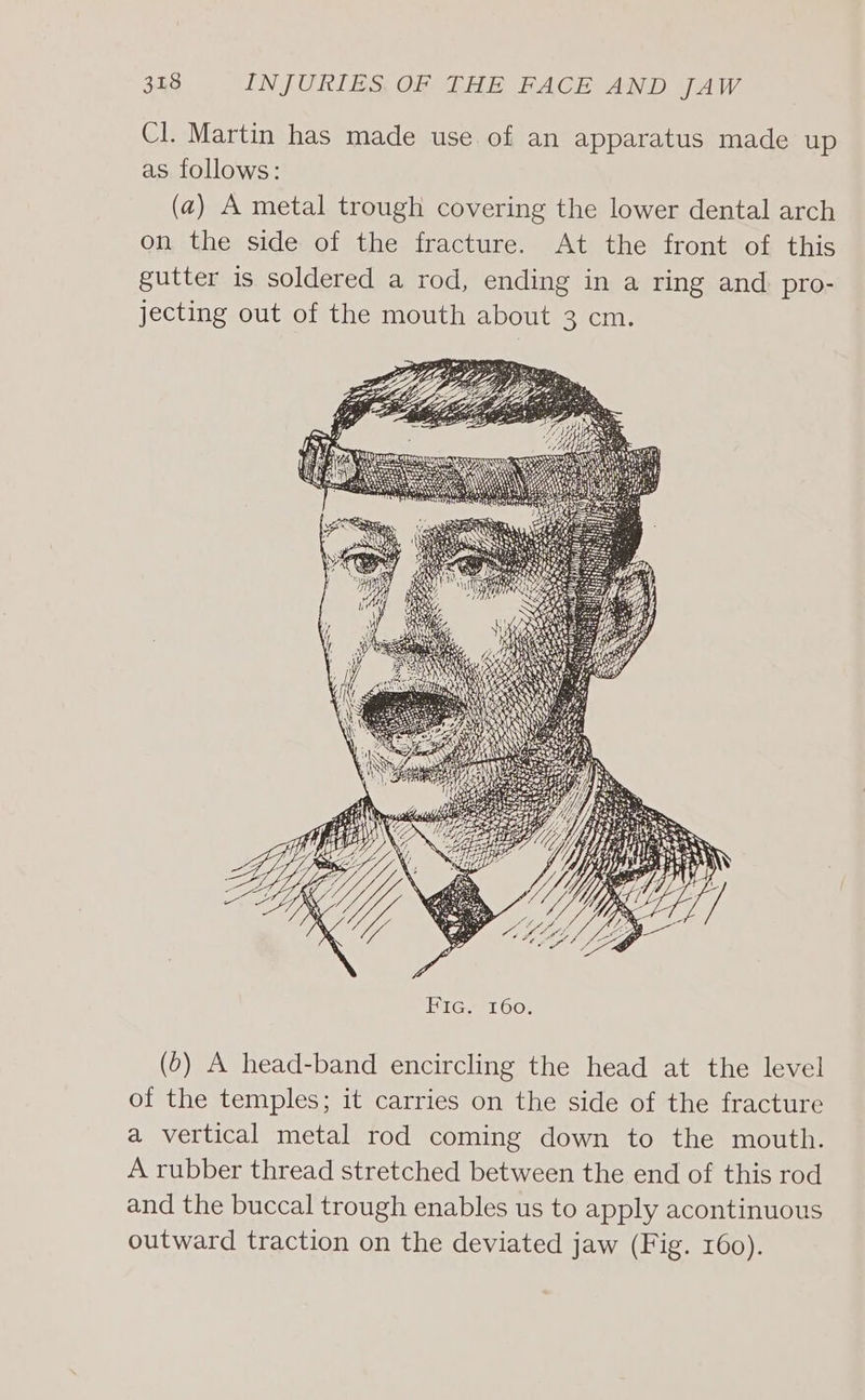 Cl. Martin has made use of an apparatus made up as follows: (2) A metal trough covering the lower dental arch on the side of the fracture. At the front of this gutter is soldered a rod, ending in a ring and pro- jecting out of the mouth about 3 cm. (0) A head-band encircling the head at the level of the temples; it carries on the side of the fracture a vertical metal rod coming down to the mouth. A rubber thread stretched between the end of this rod and the buccal trough enables us to apply acontinuous outward traction on the deviated jaw (Fig. 160).