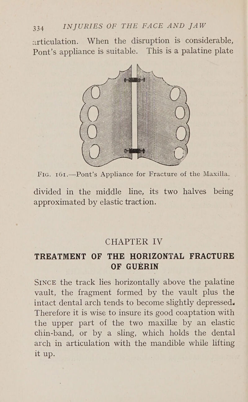 articulation. Pont’s appliance is suitable. When the disruption is considerable, This is a palatine plate tH Z 3g SOS A } sess: SSS iS cy SSS S +. ~ SSS I'ic. 161.—Pont’s Appliance for Fracture of the Maxilla. . divided in the middle line, its two halves being approximated by elastic traction. (CBU PIR eaKe UA TREATMENT OF THE HORIZONTAL FRACTURE OF GUERIN SINCE the track lies horizontally above the palatine vault, the fragment formed by the vault plus the intact dental arch tends to become slightly depressed. Therefore it is wise to insure its good coaptation with the upper part of the two maxille by an elastic chin-band, or by a sling, which holds the dental arch in articulation with the mandible while lifting it up.