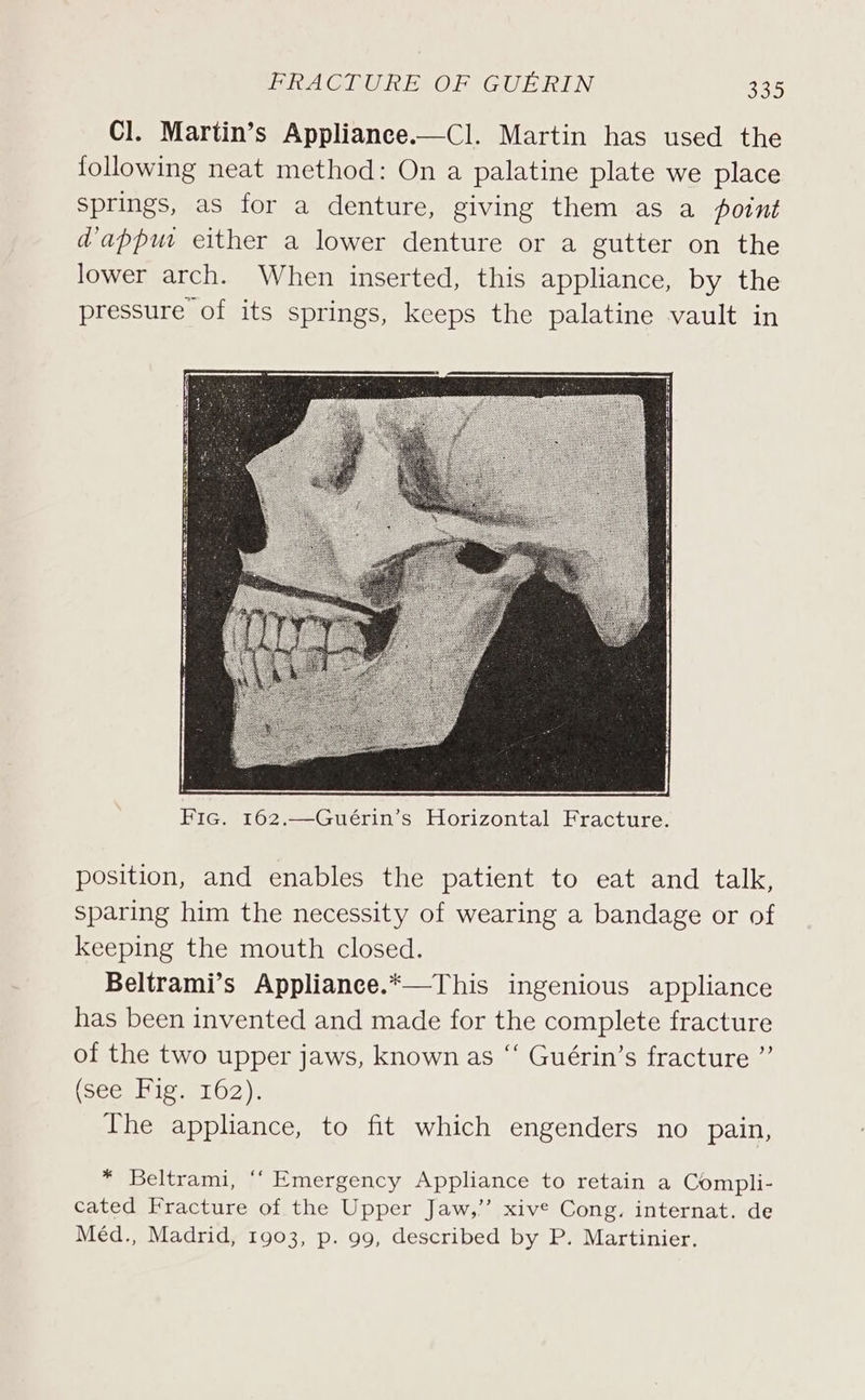 Cl. Martin’s Applianee.—Cl. Martin has used the following neat method: On a palatine plate we place springs, as for a denture, giving them as a point dappw either a lower denture or a gutter on the lower arch. When inserted, this appliance, by the pressure of its springs, keeps the palatine vault in position, and enables the patient to eat and talk, sparing him the necessity of wearing a bandage or of keeping the mouth closed. Beltrami’s Appliance.*—This ingenious appliance has been invented and made for the complete fracture of the two upper jaws, known as “‘ Guérin’s fracture ”’ (Seep ie 1072 )i The appliance, to fit which engenders no pain, * Beltrami, ‘‘ Emergency Appliance to retain a Compli- cated Fracture of the Upper Jaw,’ xive Cong. internat. de Méd., Madrid, 1903, p. 99, described by P. Martinier.