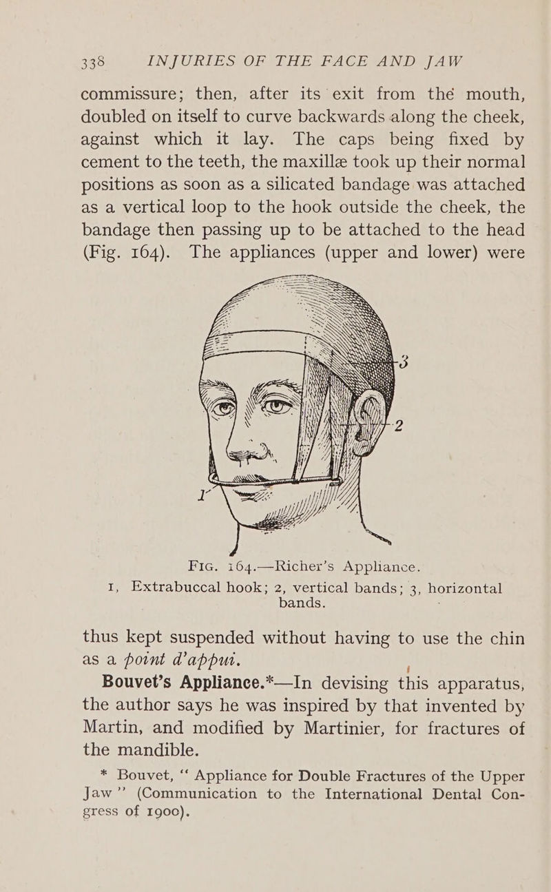 commissure; then, after its exit from thé mouth, doubled on itself to curve backwards along the cheek, against which it lay. The caps being fixed by cement to the teeth, the maxille took up their normal positions as soon as a silicated bandage was attached as a vertical loop to the hook outside the cheek, the bandage then passing up to be attached to the head (Fig. 164). The appliances (upper and lower) were Fic. 164.—Richer’s Appliance. I, Extrabuccal hook; 2, vertical bands; 3, horizontal bands. : thus kept suspended without having to use the chin as a point d’appu. Bouvet’s Appliance.*—In devising this apparatus, the author says he was inspired by that invented by Martin, and modified by Martinier, for fractures of the mandible. * Bouvet, “‘ Appliance for Double Fractures of the Upper Jaw’’ (Communication to the International Dental Con- gress Of 1900).