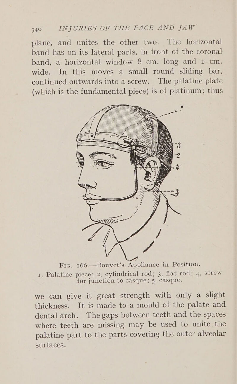 plane, and unites the other two. The horizontal band has on its lateral parts, in front of the coronal band, a horizontal window 8 cm. long and I cm. wide. In this moves a small round sliding bar, continued outwards into a screw. The palatine plate (which is the fundamental piece) is of platinum; thus BiG: 1, Palatine piece; 2, cylindrical rod; 3, flat rod; 4, screw for junction to casque; 5, casque. we can give it great strength with only a slight thickness. It is made to a mould of the palate and dental arch. The gaps between teeth and the spaces where teeth are missing may be used to unite the palatine part to the parts covering the outer alveolar surfaces.