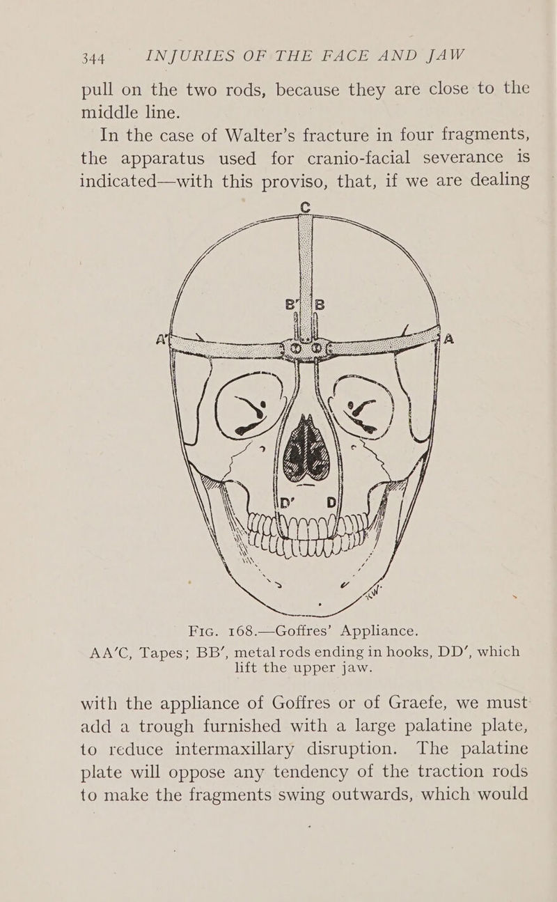 pull on the two rods, because they are close to the middle line. In the case of Walter’s fracture in four fragments, the apparatus used for cranio-facial severance is indicated—with this proviso, that, if we are dealing SAAS Sw LS Nae st SD Se SS S Eee. SSS att SMS SEAS A oe P= ~ oe Fic. 168.—Goffres’ Appliance. AA’C, Tapes; BB’, metal rods ending in hooks, DD’, which lift the upper jaw. with the appliance of Goffres or of Graefe, we must add a trough furnished with a large palatine plate, to reduce intermaxillary disruption. The palatine plate will oppose any tendency of the traction rods to make the fragments swing outwards, which would