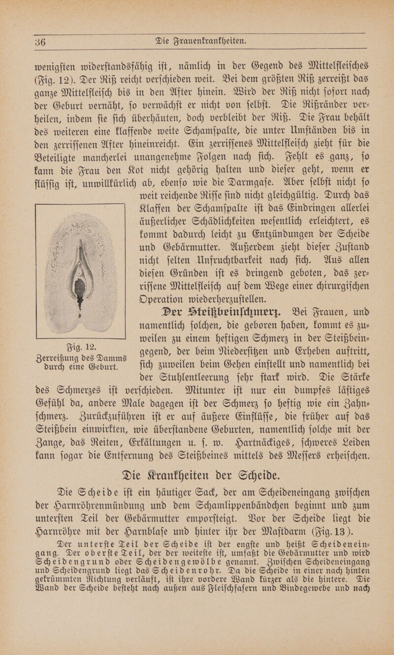 wenigſten widerſtandsfähig iſt, nämlich in der Gegend des Mittelfleiſches (Fig. 12). Der Riß reicht verſchieden weit. Bei dem größten Riß zerreißt das ganze Mittelfleiſch bis in den After hinein. Wird der Riß nicht ſofort nach der Geburt vernäht, jo verwächſt er nicht von ſelbſt. Die Rißränder ver- heilen, indem ſie ſich überhäuten, doch verbleibt der Riß. Die Frau behält des weiteren eine klaffende weite Schamſpalte, die unter Umſtänden bis in den zerriſſenen After hineinreicht. Ein zerriſſenes Mittelfleiſch zieht für die Beteiligte mancherlei unangenehme Folgen nach ſich. Fehlt es ganz, ſo kann die Frau den Kot nicht gehörig halten und dieſer geht, wenn er flüſſig iſt, unwillkürlich ab, ebenſo wie die Darmgaſe. Aber ſelbſt nicht jo weit reichende Riſſe ſind nicht gleichgültig. Durch das Klaffen der Schamſpalte iſt das Eindringen allerlei äußerlicher Schädlichkeiten weſentlich erleichtert, es kommt dadurch leicht zu Entzündungen der Scheide und Gebärmutter. Außerdem zieht dieſer Zuſtand nicht ſelten Unfruchtbarkeit nach ſich. Aus allen dieſen Gründen iſt es dringend geboten, das zer— riſſene Mittelfleiſch auf dem Wege einer chirurgiſchen Operation wiederherzuſtellen. Der Steißbeinſchmerz. Bei Frauen, und namentlich ſolchen, die geboren haben, kommt es zu⸗ : weilen zu einem heftigen Schmerz in der Steißbein⸗ ee gegend, der beim Niederſitzen und Erheben auftritt, durch eine Geburt. ſich zuweilen beim Gehen einſtellt und namentlich bei der Stuhlentleerung ſehr ſtark wird. Die Stärke des Schmerzes iſt verſchieden. Mitunter iſt nur ein dumpfes läſtiges Gefühl da, andere Male dagegen iſt der Schmerz fo heftig wie ein Zahn⸗ ſchmerz. Zurückzuführen iſt er auf äußere Einflüſſe, die früher auf das Steißbein einwirkten, wie überſtandene Geburten, namentlich ſolche mit der Zange, das Reiten, Erkältungen u. ſ. w. Hartnäckiges, ſchweres Leiden kann ſogar die Entfernung des Steißbeines mittels des Meſſers erheiſchen. Die Krankheiten der Scheide. Die Scheide iſt ein häutiger Sack, der am Scheideneingang zwiſchen der Harnröhrenmündung und dem Schamlippenbändchen beginnt und zum unterſten Teil der Gebärmutter emporſteigt. Vor der Scheide liegt die Harnröhre mit der Harnblaſe und hinter ihr der Maſtdarm (Fig. 13). Der unterſte Teil der Scheide iſt der engſte und heißt Scheid enein⸗ gang. Der oberſte Teil, der der weiteſte iſt, umfaßt die Gebärmutter und wird Scheidengrund oder Scheidengewölbe genannt. Zwiſchen Scheideneingang und Scheidengrund liegt das Scheidenrohr. Da die Scheide in einer nach hinten gekrümmten Richtung verläuft, iſt ihre vordere Wand kürzer als die hintere. Die Wand der Scheide beſteht nach außen aus Fleiſchfaſern und Bindegewebe und nach