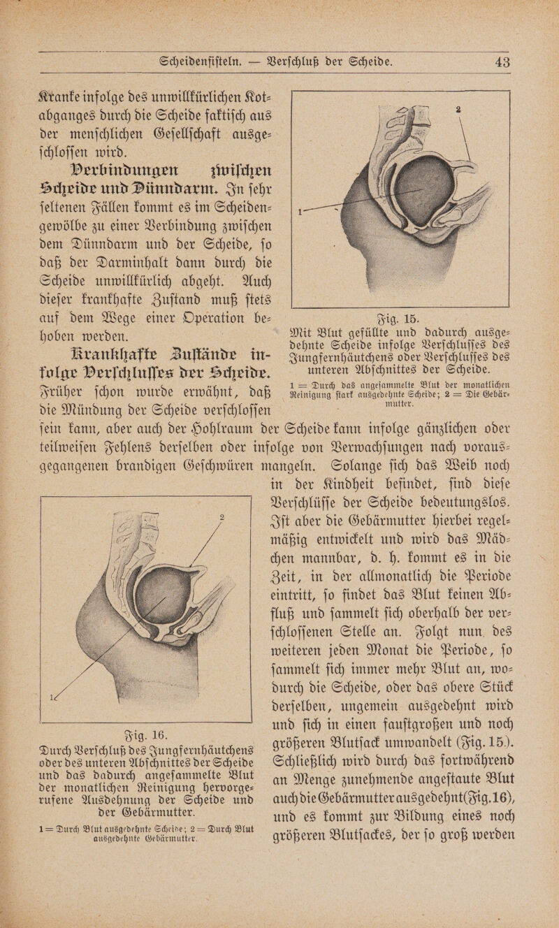 Krankea infolge des unwillkürlichen Kot⸗ abganges durch die Scheide faktiſch aus der menschlichen Geſellſchaft ausge⸗ ſchloſſen wird. Verbindungen zwiſchen Hcheide und Dünndarm. In ſehr ſeltenen Fällen kommt es im Scheiden⸗ gewölbe zu einer Verbindung zwiſchen dem Dünndarm und der Scheide, ſo daß der Darminhalt dann durch die Scheide unwillkürlich abgeht. Auch auf dem Wege einer Operation be⸗ g. 15. hoben werden. Fi Mit Blut gefüllte und dadurch ausge⸗ dehnte Scheide infolge Verſchluſſes des 1 Durch das angeſammelte Blut der monatlichen 1 Durch Blut ausgedehnte Scheide; 2= Durch Blut ausgedehnte Gebärmutter. in der Kindheit befindet, ſind dieſe Verſchlüſſe der Scheide bedeutungslos. Iſt aber die Gebärmutter hierbei regel⸗ mäßig entwickelt und wird das Mäd⸗ chen mannbar, d. h. kommt es in die eintritt, ſo findet das Blut keinen Ab⸗ fluß und ſammelt ſich oberhalb der ver- ſchloſſenen Stelle an. Folgt nun des weiteren jeden Monat die Periode, ſo ſammelt ſich immer mehr Blut an, wo⸗ durch die Scheide, oder das obere Stück derſelben, ungemein ausgedehnt wird und ſich in einen fauſtgroßen und noch größeren Blutſack umwandelt (Fig. 15). Schließlich wird durch das fortwährend an Menge zunehmende angeſtaute Blut auch die Gebärmutter ausgedehnt( Fig. 16), und es kommt zur Bildung eines noch größeren Blutſackes, der ſo groß werden