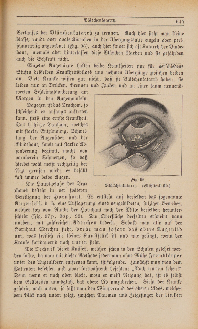 Bläschenkatarrg. Verlaufes der Bläschenkatarrh zu trennen. Auch hier ſieht man 1 0 blaſſe, runde oder ovale Körnchen in der Übergangsfalte einzeln oder perl⸗ ſchnurartig angeordnet (Fig. 96), auch hier findet ſich oft Katarrh der Binde- haut, niemals aber hinterlaſſen dieſe Bläschen Narben und ſie gefährden auch die Sehkraft nicht. Einzelne Augenärzte halten beide Krankheiten nur für verſchiedene Stufen desſelben Krankheitsbildes und nehmen Übergänge zwiſchen beiden an. Viele Kranke wiſſen gar nicht, daß ſie Bläschenkatarrh haben; ſie leiden nur an Drücken, Brennen und Jucken und an einer e nennens⸗ werten Schleimabſonderung am Morgen in den Augenwinkeln. Dagegen iſt das Trachom, ſo ſchleichend es anfangs auftreten kann, ſtets eine ernſte Krankheit. Das hitzige Trachom, welches mit ſtarker Entzündung, Schwel— lung der Augenlider und der Bindehaut, ſowie mit ſtarker Ab— ſonderung beginnt, macht von vornherein Schmerzen, ſo daß hierbei wohl meiſt rechtzeitig der Arzt gerufen wird; es befällt 5 faſt immer beide Augen. N N Fig. 96. Die Hauptgefahr des Tra. läschenkatarrh. (Blitzlichtbild.) choms beſteht in der ſpäteren a | 155 Beteiligung der Hornhaut. Es entſteht auf derſelben das ſogenannte Augenſell, d. h. eine Auflagerung eines neugebildeten, ſulzigen Gewebes, welches ſich vom Rande der Hornhaut nach der Mitte derſelben herunter— ſchiebt (Fig. 97 p, 98p, 99). Die Oberfläche derſelben erſcheint dann uneben, mit zahlreichen Aderchen bedeckt. Sobald man alſo auf der Hornhaut Aderchen ſieht, drehe man ſofort das obere Augenlid um, was freilich ein kleines Kunſtſtück iſt und nur gelingt, wenn der Kranke fortdauernd nach unten ſieht. ( Die Technik dieſes Kniffes, welcher ſchon in den Schulen gelehrt wer⸗ den ſollte, da man mit dieſer Methode jedermann ohne Mühe Fremdkörper unter den Augenlidern entfernen kann, iſt folgende. Zunächſt muß man dem Patienten befehlen und zwar fortwährend befehlen: „Nach unten ſehen!“ Denn wenn er nach oben blickt, wozu er meiſt Neigung hat, iſt es ſelbſt dem Geübteſten unmöglich, das obere Lid umzudrehen. Sieht der Kranke N gehörig nach unten, ſo faßt man den Wimperrand des oberen Lides, welches dem Blick nach unten folgt, zwiſchen Dau men und Zeigefinger der linken r. a ni ⁵˙ AA ul nn ien na