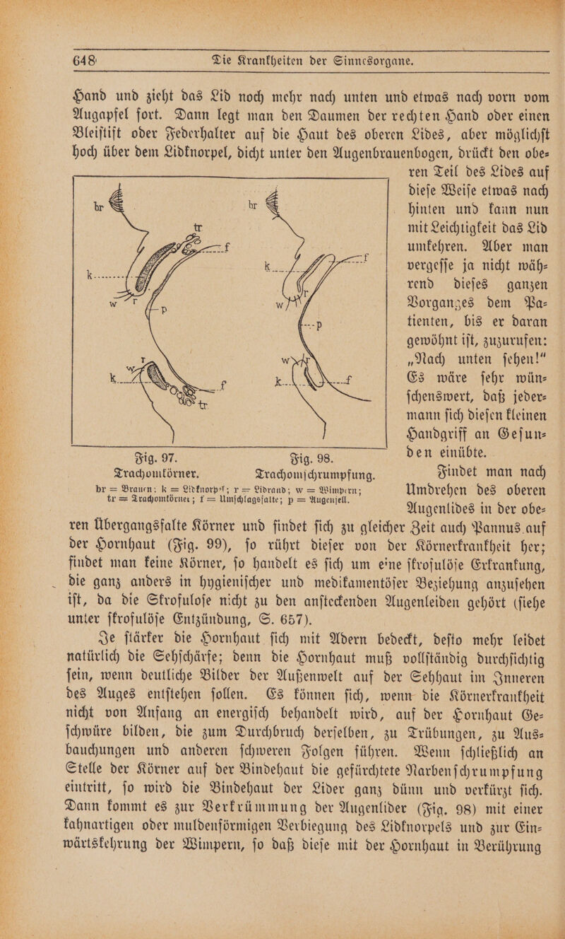 9 N 1 e e e e en J ar * 1 E ” 648 Die Krankheiten der Sinnesorgane. Hand und zieht das Lid noch mehr nach unten und etwas nach vorn vom Augapfel fort. Dann legt man den Daumen der rechten Hand oder einen Bleiſtift oder Federhalter auf die Haut des oberen Lides, aber möglichſt hoch über dem Lidknorpel, dicht unter den Augenbrauenbogen, drückt den obe— ren Teil des Lides auf dieſe Weiſe etwas nach hinten und kann nun mit Leichtigkeit das Lid umkehren. Aber man vergeſſe ja nicht wäh— rend dieſes ganzen Vorganges dem Pa⸗— tienten, bis er daran gewöhnt iſt, zuzurufen: „Nach unten ſehen!“ Es wäre ſehr wün⸗ ſchenswert, daß jeder: mann ſich dieſen kleinen Handgriff an Geſun⸗ den einübte. tr eee 1 5 = Umfoplagsjalte; p= = Augenſell. Augenlides in der obe— ren Übergangsfalte Körner und findet fich zu gleicher Zeit auch Pannus auf der Hornhaut (Fig. 99), ſo rührt dieſer von der Körnerkrankheit her; findet man keine Körner, jo handelt es ſich um eine ſkrofulöſe Erkrankung, die ganz anders in hygieniſcher und medikamentöſer Beziehung anzuſehen iſt, da die Skrofuloſe nicht 85 den anſteckenden Augenleiden gehört (ſiehe unter ſkrofulöſe Entzündung, S. 657). Je ſtärker die Hornhaut ſich mit Adern bedeckt, deſto mehr leidet natürlich die Sehſchärfe; denn die Hornhaut muß vollſtändig dür hehe ſein, wenn deutliche Bilder der Außenwelt auf der Sehhaut im Inneren des Auges entſtehen ſollen. Es können ſich, wenn die Körnerkrankheit nicht von Anfang an energiſch behandelt wird, auf der Hornhaut Ge— ſchwüre bilden, die zum Durchbruch derſelben, zu Trübungen, zu Aus— bauchungen und anderen ſchweren Folgen führen. Wenn ſchließlich an Stelle der Körner auf der Bindehaut die gefürchtete Narben ſchrumpfung eintritt, ſo wird die Bindehaut der Lider ganz dünn und verkürzt ſich. Dann kommt es zur Verkrümmung der Augenlider (Fig. 98) mit einer kahnartigen oder muldenförmigen Verbiegung des Lidknorpels und zur Ein: wärtskehrung der Wimpern, ſo daß dieſe mit der Hornhaut in Berührung