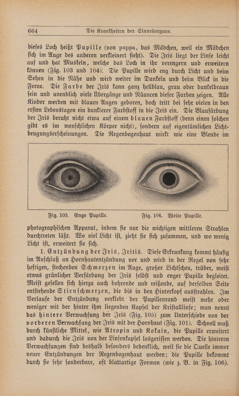 dieſes Loch heißt Pupille (von puppa, das Mädchen, weil ein Mädchen ſich im Auge des anderen verkleinert ſieht). Die Iris liegt der Linſe leicht auf und hat Muskeln, welche das Loch in ihr verengern und erweitern können (Fig. 103 und 104). Die Pupille wird eng durch Licht und beim Sehen in die Nähe und wird weiter im Dunkeln und beim Blick in die Ferne. Die Farbe der Iris kann ganz hellblau, grau oder dunkelbraun jein und unendlich viele Übergänge und Nüancen dieſer Farben zeigen. Alle Kinder werden mit blauen Augen geboren, doch tritt bei ſehr vielen in den erſten Lebenstagen ein dunklerer Farbſtoff in die Iris ein. Die Blaufärbung der Iris beruht nicht etwa auf einem blauen Farbſtoff (denn einen ſolchen gibt es im menſchlichen Körper nicht), ſondern auf eigentümlichen Licht⸗ beugungserſcheinungen. Die Regenbogenhaut wirkt wie eine Blende im photographiſchen Apparat, indem ſie nur die wichtigen mittleren Strahlen durchtreten läßt. Wo viel Licht iſt, zieht ſie ſich zuſammen, und wo wenig Licht iſt, erweitert ſie ſich. 1. Entzündung der Iris, Iritis. Dieſe Erkrankung kommt häufig im Anſchluß an Hornhautentzündung vor und wird in der Regel von ſehr heftigen, ſtechenden Schmerzen im Auge, großer Lichtſcheu, trüber, meiſt etwas grünlicher Verfärbung der Iris ſelbſt und enger Pupille begleitet. Meiſt geſellen ſich hierzu auch bohrende und reißende, auf derſelben Seite entſtehende Stirnſchmerzen, die bis in den Hinterkopf ausſtrahlen. Im Verlaufe der Entzündung verklebt der Pupillenrand meiſt mehr oder weniger mit der hinter ihm liegenden Kapſel der Kriſtalllinſe; man nennt das hintere Verwachſung der Iris (Fig. 105) zum Unterſchiede von der vorderen Verwachſung der Iris mit der Hornhaut (Fig. 101). Schnell muß durch künſtliche Mittel, wie Atropin und Kokain, die Pupille erweitert und dadurch die Iris von der Linſenkapſel losgeriſſen werden. Die hinteren Verwachſungen ſind deshalb beſonders bedenklich, weil ſie die Quelle immer | neuer Entzündungen der Regenbogenhaut werden; die Pupille bekommt durch ſie ſehr ſonderbare, oft blattartige Formen (wie z. B. in Fig. 106).
