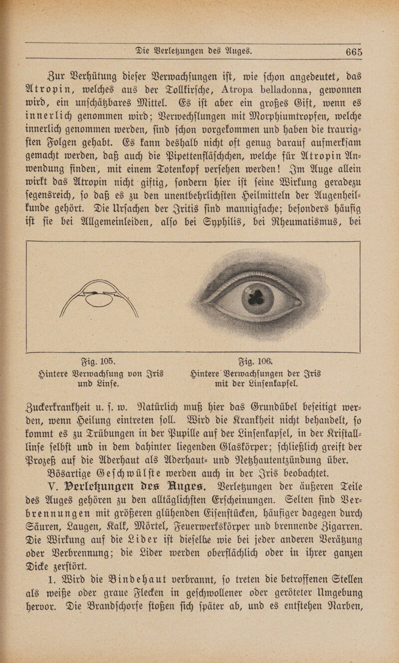 S nee 3 N 9 Die Verletzungen des Auges. 665 Zur Verhütung dieſer Verwachſungen iſt, wie ſchon angedeutet, das Atropin, welches aus der Tollkirſche, Atropa belladonna, gewonnen wird, ein unſchätzbares Mittel. Es iſt aber ein großes Gift, wenn es innerlich genommen wird; Verwechſlungen mit Morphiumtropfen, welche innerlich genommen werden, ſind ſchon vorgekommen und haben die traurig— ſten Folgen gehabt. Es kann deshalb nicht oft genug darauf aufmerkſam gemacht werden, daß auch die Pipettenfläſchchen, welche für Atropin An: wendung finden, mit einem Totenkopf verſehen werden! Im Auge allein wirkt das Atropin nicht giftig, ſondern hier iſt ſeine Wirkung geradezu ſegensreich, ſo daß es zu den unentbehrlichſten Heilmitteln der Augenheil— kunde gehört. Die Urſachen der Iritis ſind mannigfache; beſonders häufig Fig. 105. | Fig. 106. Hintere Verwachſung von Iris Hintere Verwachſungen der Iris und Linſe. f mit der Linſenkapſel. Zuckerkrankheit u. ſ. w. Natürlich muß hier das Grundübel beſeitigt wer⸗ den, wenn Heilung eintreten ſoll. Wird die Krankheit nicht behandelt, ſo kommt es zu Trübungen in der Pupille auf der Linſenkapſel, in der Kriſtall⸗ linſe ſelbſt und in dem dahinter liegenden Glaskörper; ſchließlich greift der Prozeß auf die Aderhaut als Aderhaut⸗ und Netzhautentzündung über. Bösartige Geſchwülſte werden auch in der Iris beobachtet. V. Berlekungen des Auges. Verletzungen der äußeren Teile des Auges gehören zu den alltäglichſten Erſcheinungen. Selten ſind Ver⸗ brennungen mit größeren glühenden Eiſenſtücken, häufiger dagegen durch Säuren, Laugen, Kalk, Mörtel, Feuerwerkskörper und brennende Zigarren. Die Wirkung auf die Lider iſt dieſelbe wie bei jeder anderen Verätzung oder Verbrennung; die Lider werden oberflächlich oder in ihrer ganzen Dicke zerſtört. | | | 1. Wird die Bindehaut verbrannt, fo treten die betroffenen Stellen als weiße oder graue Flecken in geſchwollener oder geröteter Umgebung hervor. Die Brandſchorfe ſtoßen ſich ſpäter ab, und es entſtehen Narben,