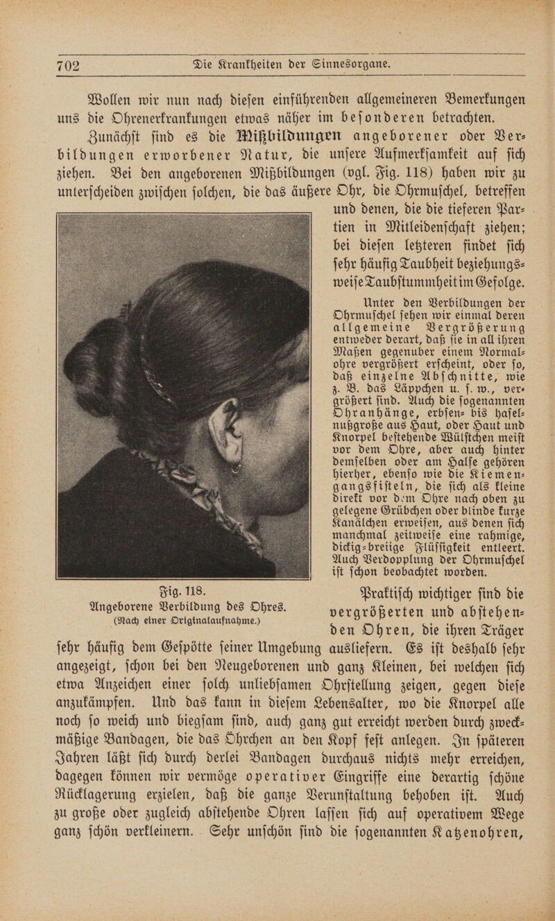 Wollen wir nun nach dieſen einführenden allgemeineren Bemerkungen uns die Ohrenerkrankungen etwas näher im beſonderen betrachten. Zunächſt find es die Mißbildungen angeborener oder Ver⸗ bildungen erworbener Natur, die unſere Aufmerkſamkeit auf ſich ziehen. Bei den angeborenen Mißbildungen (vgl. Fig. 118) haben wir zu 1 zwiſchen 5 die das äußere Ohr, die Ohrmuſchel, betreffen tien in Mitleidenſchaft ziehen; bei dieſen letzteren findet ſich ſehr häufig Taubheit beziehungs⸗ weiſe Taubſtummheit im Gefolge. Unter den Verbildungen der Ohrmuſchel ſehen wir einmal deren allgemeine Vergrößerung entweder derart, daß ſie in all ihren Maßen gegenuber einem Normal⸗ ohre vergrößert erſcheint, oder ſo, daß einzelne Abſchnitte, wie z. B. das Läppchen u. ſ. w., ver⸗ größert ſind. Auch die ſogenannten Ohranhänge, erbſen⸗- bis haſel⸗ nußgroße aus Haut, oder Haut und Knorpel beſtehende Wülſtchen meiſt vor dem Ohre, aber auch hinter demſelben oder am Halſe gehören hierher, ebenſo wie die Kiemen⸗ gangsfiſteln, die ſich als kleine direkt vor dem Ohre nach oben zu gelegene Grübchen oder blinde kurze Kanälchen erweiſen, aus denen ſich manchmal zeitweiſe eine rahmige, dickig⸗breiige Flüſſigkeit entleert. Auch Verdopplung der Ohrmuſchel iſt ſchon beobachtet worden. Jig. 118. Praktiſch wichtiger ſind die Angeborene Verbildung des Ohres. vergrößerten und abſtehen— (Nach einer Originalaufnahme.) . 5 | | den Ohren, die ihren Träger ſehr häufig dem Geſpötte ſeiner Umgebung ausliefern. Es iſt deshalb ſehr angezeigt, ſchon bei den Neugeborenen und ganz Kleinen, bei welchen ſich etwa Anzeichen einer ſolch unliebſamen Ohrſtellung zeigen, gegen dieſe anzukämpfen. Und das kann in dieſem Lebensalter, wo die Knorpel alle noch ſo weich und biegſam ſind, auch ganz gut erreicht werden durch zweck— mäßige Bandagen, die das Ohrchen an den Kopf feſt anlegen. In ſpäteren Jahren läßt ſich durch derlei Bandagen durchaus nichts mehr erreichen, dagegen können wir vermöge operativer Eingriffe eine derartig ſchöne Rücklagerung erzielen, daß die ganze Verunſtaltung behoben iſt. Auch zu große oder zugleich abſtehende Ohren laſſen ſich auf operativem Wege ganz ſchön verkleinern. Sehr unſchön ſind die ſogenannten Katzenohren,