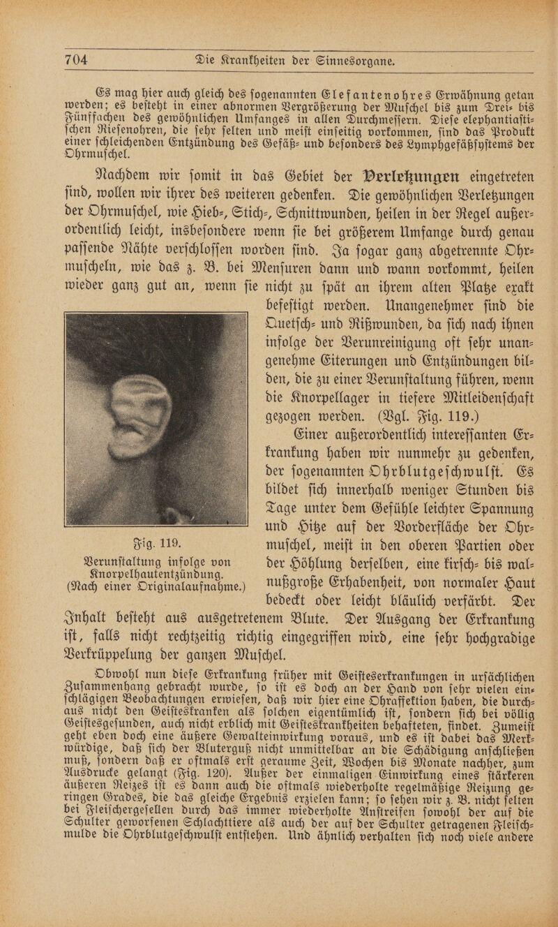 Es mag hier auch gleich des ſogenannten Elefantenohres Erwähnung getan werden; es beſteht in einer abnormen Vergrößerung der Muſchel bis zum Drei⸗ bis Fünffachen des gewöhnlichen Umfanges in allen Durchmeſſern. Dieſe elephantiaſti⸗ ſchen Rieſenohren, die ſehr ſelten und meiſt einſeitig vorkommen, ſind das Produkt einer ſchleichenden Entzündung des Gefäß- und beſonders des Lymphgefäßſyſtems der Ohrmuſchel. Nachdem wir ſomit in das Gebiet der Perlekungen eingetreten ſind, wollen wir ihrer des weiteren gedenken. Die gewöhnlichen Verletzungen der Ohrmuſchel, wie Hieb⸗, Stich-, Schnittwunden, heilen in der Regel außer⸗ ordentlich leicht, insbeſondere wenn ſie bei größerem Umfange durch genau paſſende Nähte verſchloſſen worden ſind. Ja ſogar ganz abgetrennte Ohr⸗ muſcheln, wie das z. B. bei Menſuren dann und wann vorkommt, heilen wieder ganz gut an, wenn ſie nicht zu ſpät an ihrem alten Platze exakt befeſtigt werden. Unangenehmer ſind die Quetſch⸗ und Rißwunden, da ſich nach ihnen infolge der Verunreinigung oft ſehr unan- genehme Eiterungen und Entzündungen bil⸗ den, die zu einer Verunſtaltung führen, wenn die Knorpellager in tiefere Mitleidenſchaft gezogen werden. (Vgl. Fig. 119.) Einer außerordentlich intereſſanten Er⸗ krankung haben wir nunmehr zu gedenken, der ſogenannten Ohrblutgeſchwulſt. Es bildet ſich innerhalb weniger Stunden bis Tage unter dem Gefühle leichter Spannung und Hitze auf der Vorderfläche der Ohr⸗ Fig. 119. muſchel, meiſt in den oberen Partien oder Verunſtaltung infolge von der Höhlung derſelben, eine kirſch- bis wal⸗ (Mach eigen nußgroße Erhabenheit, von normaler Haut bedeckt oder leicht bläulich verfärbt. Der Inhalt beſteht aus ausgetretenem Blute. Der Ausgang der Erkrankung iſt, falls nicht rechtzeitig richtig eingegriffen wird, eine ſehr hochgradige Verkrüppelung der ganzen Muſchel. Obwohl nun dieſe Erkrankung früher mit Geiſteserkrankungen in urſächlichen Zuſammenhang gebracht wurde, ſo iſt es doch an der Hand von ſehr vielen ein— ſchlägigen Beobachtungen erwieſen, daß wir hier eine Ohraffektion haben, die durch⸗ aus nicht den Geiſteskranken als ſolchen eigentümlich iſt, ſondern ſich bei völlig Geiſtesgeſunden, auch nicht erblich mit Geiſteskrankheiten behafteten, findet. Zumeiſt geht eben doch eine äußere Gewalteinwirkung voraus, und es iſt dabei das Merk⸗ würdige, daß ſich der Bluterguß nicht unmittelbar an die Schädigung anſchließen muß, ſondern daß er oftmals erſt geraume Zeit, Wochen bis Monate nachher, zum Ausdrucke gelangt (Fig. 120). Außer der einmaligen Einwirkung eines ſtärkeren äußeren Reizes iſt es dann auch die oftmals wiederholte regelmäßige Reizung ge ringen Grades, die das gleiche Ergebnis erzielen kann; ſo ſehen wir z. B. nicht ſelten bei Fleiſchergeſellen durch das immer wiederholte Anſtreifen ſowohl der auf die Schulter geworfenen Schlachttiere als auch der auf der Schulter getragenen Fleiſch⸗ mulde die Ohrblutgeſchwulſt entſtehen. Und ähnlich verhalten ſich noch viele andere