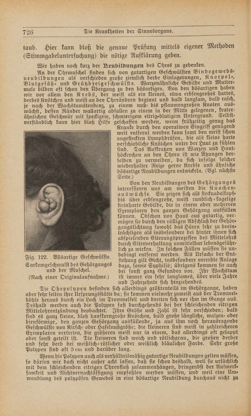 taub. Hier kann bloß die genaue Prüfung mittels eigener Methoden (Stimmgabelunterſuchung) die nötige Aufklärung geben. Wir haben noch kurz der Neubildungen des Ohres zu gedenken. An der Ohrmuſchel finden ſich von gutartigen Geſchwülſten Bindegewebs⸗ neubildungen als verſchieden große ziemlich derbe Einlagerungen, Knorpel“, Blutgefäß⸗ und Grützbreigeſchwülſte. Warzenähnliche Gebilde und Mutter⸗ male bilden oft ſchon den Übergang zu den bösartigen. Von den bösartigen haben wir vor allem den Krebs, der meiſt als ein kleines, etwa erbſengroßes hartes, derbes Knötchen und meiſt an den Ohrrändern beginnt und bald langſam, bald raſch, je nach der Wachstumstendenz, zu einem nuß⸗ bis pflaumengroßen Knoten aus⸗ wächſt, deſſen Ränder wallartig abfallen zu einem in der Mitte gelegenen, krater⸗ ähnlichen Geſchwür mit ſpeckigem, ſchmierigem eitrig⸗blutigem Untergrund. Selbſt⸗ verſtändlich kann hier bloß Hilfe geſchaffen werden, wenn frühzeitig genug das Kranke durch den operativen Eingriff genügend weit entfernt werden kann ſamt den meiſt ſchon angeſteckten Lymphdrüſen, die als kleine harte verſchiebliche Knötchen unter der Haut zu fühlen ſind. Das Aufkratzen von Warzen und Haut⸗ höckerchen an den Ohren iſt wie Atzungen der⸗ ſelben zu vermeiden, da ſich infolge ſolcher wiederholter Reize gerne Krebſe und ähnliche Sei Neubildungen entwickeln. (Vgl. nächſte eite.) Von den Neubildungen des Gehörganges intereſſieren uns am meiſten die Knochen⸗ auswüchſe. Sie zeigen ſich als ſtecknadelkopf⸗ bis über erbſengroße, meiſt rundlich⸗kugelige ſteinharte Gebilde, die in einem oder mehreren Exemplaren den ganzen Gehörgang ausfüllen können. Obſchon von Haus aus gutartig, ver⸗ mögen ſie durch den völligen Abſchluß der Gehör⸗ trächtigen als insbeſondere bei hinter ihnen ſich abſpielenden Eiterungsprozeſſen des Mittelohrs durch Eiterverhaltung unmittelbar lebensgefähr⸗ __ 5 zu 1 5 In 8 15 ln 1 ; » ;  edingt entfernt werden. Als Urſache der Ent⸗ e e ſtehung gilt Gicht, insbeſondere vererbte Anlage Sarkomgeſchwulſt des Gehörganges dazu, ſowie Syphilis; übrigens kommen ſie auch und der Muſchel. bei ſonſt ganz Gefunden vor. Ihr Wachstum (Nach einer Originalaufnahme.) iſt immer ein ſehr langſames, über viele Jahre und Jahrzehnte ſich hinziehendes. Die Ohrpolypen befinden ſich allerdings größtenteils im Gehörgange, haben aber ſehr ſelten ihre Urſprungsſtätte da; ſie kommen vielmehr zumeiſt aus der Trommel⸗ höhle heraus durch ein Loch im Trommelfell und breiten ſich vor ihm im Gange aus. Deshalb werden auch die Polypen faſt durchgehends bei der ſchleichenden eitrigen Mittelohrentzündung beobachtet. Ihre Größe und Zahl iſt ſehr verſchieden; bald ſind es ganz kleine, bloß hanfkorngroße Knötchen, bald große längliche, walzen⸗ oder birnförmige, den ganzen Gehörgang ausfüllende, ja aus ihm noch herausragende Geſchwülſte von Kirſch- oder Haſelnußgröße; die kleineren ſind meiſt in zahlreicheren Exemplaren vertreten, die größeren meiſt nur in einem, das allerdings oft gelappt oder ſonſt geteilt iſt. Die kleineren ſind weich und rötlichgrau, die großen derber und ſehr derb bei weißlich-rötlicher oder weißlich bläulicher Farbe. Sehr große Polypen find oft Z em und darüber lang. Wenn die Polypen auch als verhältnismäßig gutartige Neubildungen gelten müſſen, ſo dürfen wir doch nicht außer acht laſſen, daß ſie ſchon deshalb, weil ſie urſächlich mit dem ſchleichenden eitrigen Ohrenfluß zuſammenhängen, dringendſt der Aufmerk⸗ ſamkeit und Nichtvernachläſſigung empfohlen werden müſſen, und weil eine Um⸗ wandlung des polypöſen Gewebes in eine bösartige Neubildung durchaus nicht zu