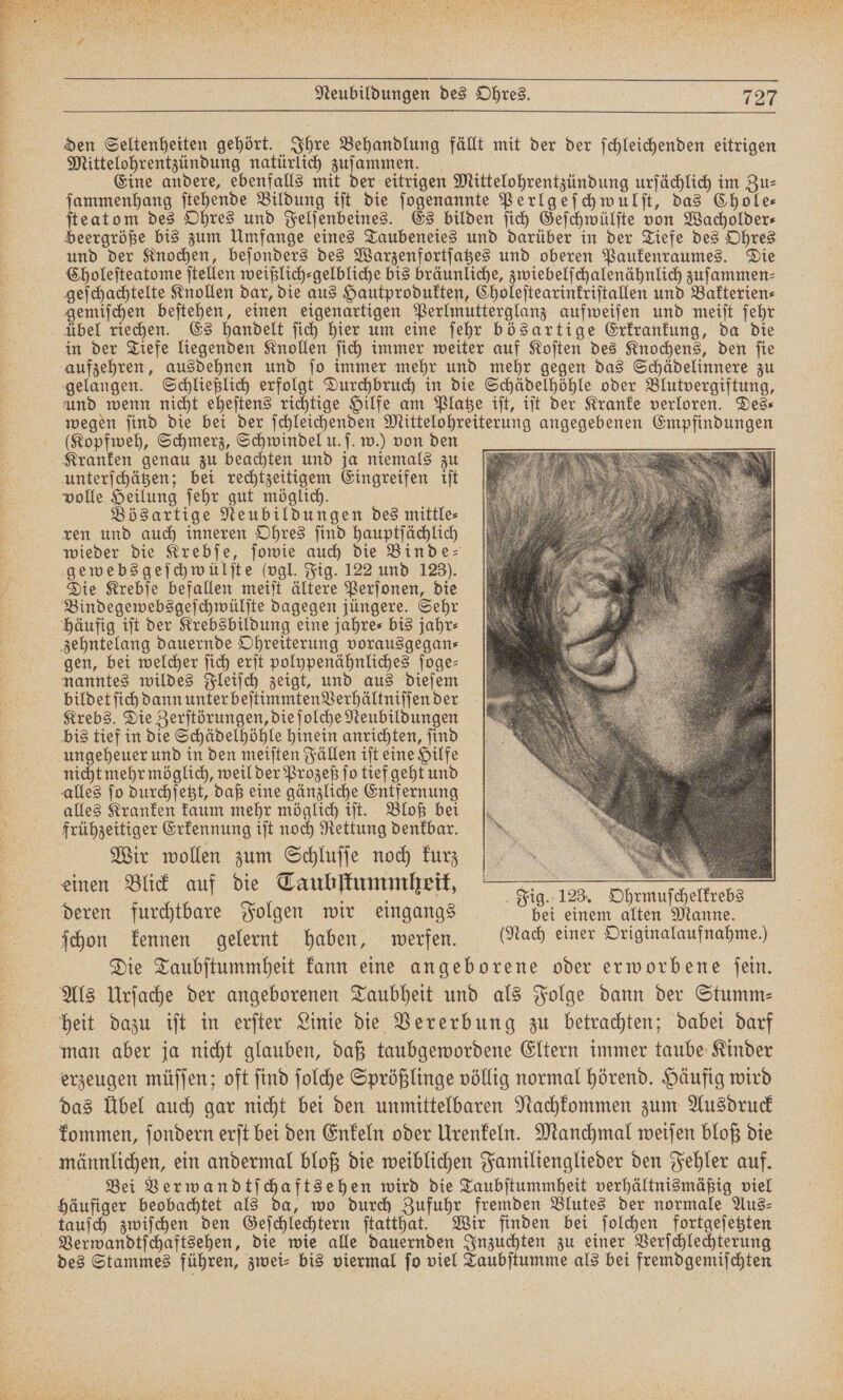 den Seltenheiten gehört. Ihre Behandlung fällt mit der der ſchleichenden eitrigen Mittelohrentzündung natürlich zuſammen. | Eine andere, ebenfalls mit der eitrigen Mittelohrentzündung urſächlich im Zu⸗ ſammenhang ſtehende Bildung iſt die ſogenannte Perlgeſchwulſt, das Chole⸗ ſteatom des Ohres und Felſenbeines. Es bilden ſich Geſchwülſte von Wacholder⸗ beergröße bis zum Umfange eines Taubeneies und darüber in der Tiefe des Ohres und der Knochen, beſonders des Warzenfortſatzes und oberen Paukenraumes. Die Choleſteatome ſtellen weißlich⸗gelbliche bis bräunliche, zwiebelſchalenähnlich zuſammen⸗ geſchachtelte Knollen dar, die aus Hautprodukten, Choleſtearinkriſtallen und Bakterien⸗ gemiſchen beſtehen, einen eigenartigen Perlmutterglanz aufweiſen und meiſt ſehr übel riechen. Es handelt ſich hier um eine ſehr bösartige Erkrankung, da die in der Tiefe liegenden Knollen ſich immer weiter auf Koſten des Knochens, den fie aufzehren, ausdehnen und ſo immer mehr und mehr gegen das Schädelinnere zu gelangen. Schließlich erfolgt Durchbruch in die Schädelhöhle oder Blutvergiftung, und wenn nicht eheſtens richtige Hilfe am Platze iſt, iſt der Kranke verloren. Des⸗ wegen ſind die bei der ſchleichenden Mittelohreiterung angegebenen Empfindungen (Kopfweh, Schmerz, Schwindel u. ſ. w.) von den Kranken genau zu beachten und ja niemals zu unterſchätzen; bei rechtzeitigem Eingreifen iſt volle Heilung ſehr gut möglich. Bösartige Neubildungen des mittle⸗ ren und auch inneren Ohres ſind hauptſächlich wieder die Krebſe, ſowie auch die Binde⸗ gewebsgeſchwülſte (vgl. Fig. 122 und 123). Die Krebſe befallen meiſt ältere Perſonen, die Bindegewebsgeſchwülſte dagegen jüngere. Sehr häufig iſt der Krebsbildung eine jahre⸗ bis jahr⸗ zehntelang dauernde Ohreiterung vorausgegan⸗ gen, bei welcher ſich erſt polypenähnliches ſoge⸗ nanntes wildes Fleiſch zeigt, und aus dieſem bildet ſich dann unter beſtimmten Verhältniſſen der Krebs. Die Zerſtörungen, die ſolche Neubildungen bis tief in die Schädelhöhle hinein anrichten, ſind ungeheuer und in den meiſten Fällen iſt eine Hilfe nicht mehr möglich, weil der Prozeß ſo tief geht und alles ſo durchſetzt, daß eine gänzliche Entfernung alles Kranken kaum mehr möglich iſt. Bloß bei frühzeitiger Erkennung iſt noch Rettung denkbar. Wir wollen zum Schluſſe noch kurz einen Blick auf die Taubſtummheik, a deren furchtbare Folgen wir eingangs Si e a ſchon kennen gelernt haben, werfen. Mach einer Originalaufnahme!) Die Taubſtummheit kann eine angeborene oder erworbene ſein. Als Urſache der angeborenen Taubheit und als Folge dann der Stumm⸗ heit dazu iſt in erſter Linie die Vererbung zu betrachten; dabei darf man aber ja nicht glauben, daß taubgewordene Eltern immer taube Kinder erzeugen müſſen; oft ſind ſolche Sprößlinge völlig normal hörend. Häufig wird das Übel auch gar nicht bei den unmittelbaren Nachkommen zum Ausdruck kommen, ſondern erſt bei den Enkeln oder Urenkeln. Manchmal weiſen bloß die männlichen, ein andermal bloß die weiblichen Familienglieder den Fehler auf. Bei Verwandtſchaftsehen wird die Taubſtummheit verhältnismäßig viel häufiger beobachtet als da, wo durch Zufuhr fremden Blutes der normale Aus⸗ tauſch zwiſchen den Geſchlechtern ſtatthat. Wir finden bei ſolchen fortgeſetzten Verwandtſchaftsehen, die wie alle dauernden Inzuchten zu einer Verſchlechterung des Stammes führen, zwei- bis viermal fo viel Taubſtumme als bei fremdgemiſchten