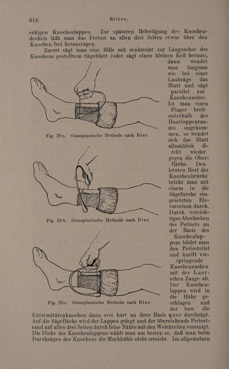 eckigen Knochenlappen. Zur späteren Befestigung des Knochen- decekels läßt man das Periost an allen drei Seiten etwas über den Knochen frei herausragen. Zuerst sägt man eine Rille mit senkrecht zur Längsachse des Knochens gestelltem Sägeblatt (oder sägt einen kleinen Keil heraus), . dann wendet man langsam wie bei einer Laubsäge das Blatt und sägt parallel zur Knochenachse. Ist man einen Finger breit unterhalb des Hautlappenran- . des angekom- Fig. 28a. Osteoplastische Methode nach Bier. men, so wendet sich das Blatt allmählich di- rekt wieder gegen die Ober- fläche. Den letzten Rest der Knochenbrücke bricht man mit einem in die Sägefurche ein- gesetzten Ele- vatorium durch. > Durch vorsich- Fig. 28b. tiges Abschieben des Periosts an / der Basis des 4 | Knochenlap- pens bildet man den Perioststiel und kneift vor- springende Knochenzacken mit der Luer- schen Zange ab. Der Knochen- ——= = N = N > Se lappen. wird in —X EI, K R 2ER die Höhe ge- Fig. 28c. Osteoplastische Methode nach Bier. schlagen und M der bzw. die Extremitätenknochen dann erst hart an ihrer Basis quer durchsägt. Auf die Sägefläche wird der Lappen gelegt und der überstehende Periost- rand auf allen drei Seiten durch feine Nähte mit den Weichteilen vereinigt. Die Dieke des Knochenlappens wählt man am besten so, daß man beim Durchsägen des Knochens die Markhöhle nicht erreicht. Im allgemeinen