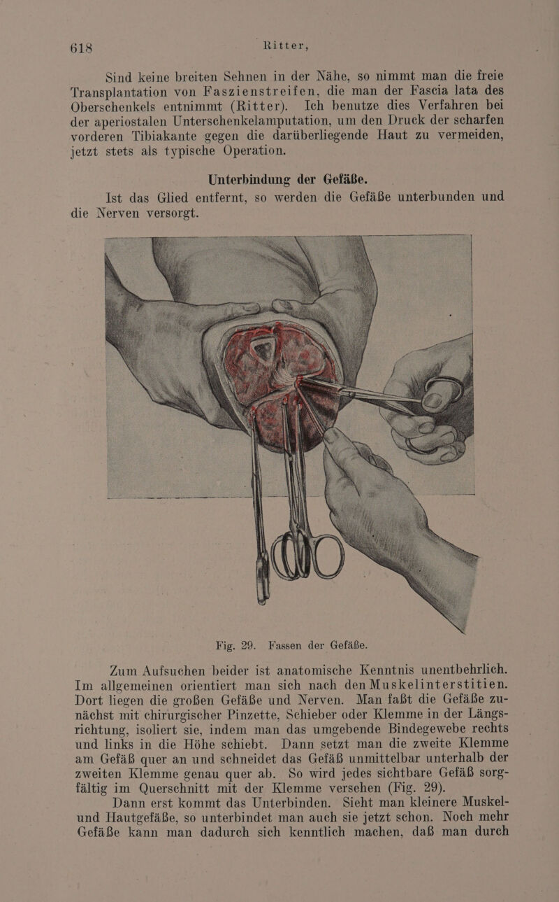 Sind keine breiten Sehnen in der Nähe, so nimmt man die freie Transplantation von Faszienstreifen, die man der Fascia lata des Oberschenkels entnimmt (Ritter). Ich benutze dies Verfahren bei der aperiostalen Unterschenkelamputation, um den Druck der scharfen vorderen Tibiakante gegen die darüberliegende Haut zu vermeiden, jetzt stets als typische Operation. Unterbindung der Gefäße. Ist das Glied entfernt, so werden die Gefäße unterbunden und die Nerven versorgt. Zum Aufsuchen beider ist anatomische Kenntnis unentbehrlich. Im allgemeinen orientiert man sich nach den Muskelinterstitien. Dort liegen die großen Gefäße und Nerven. Man faßt die Gefäße zu- nächst mit chirurgischer Pinzette, Schieber oder Klemme in der Längs- richtung, isoliert sie, indem man das umgebende Bindegewebe rechts und links in die Höhe schiebt. Dann setzt man die zweite Klemme am Gefäß quer an und schneidet das Gefäß unmittelbar unterhalb der zweiten Klemme genau quer ab. So wird jedes sichtbare Gefäß sorg- fältig im Querschnitt mit der Klemme versehen (Fig. 29). Dann erst kommt das Unterbinden. Sieht man kleinere Muskel- und Hautgefäße, so unterbindet man auch sie jetzt schon. Noch mehr Gefäße kann man dadurch sich kenntlich machen, daß man durch