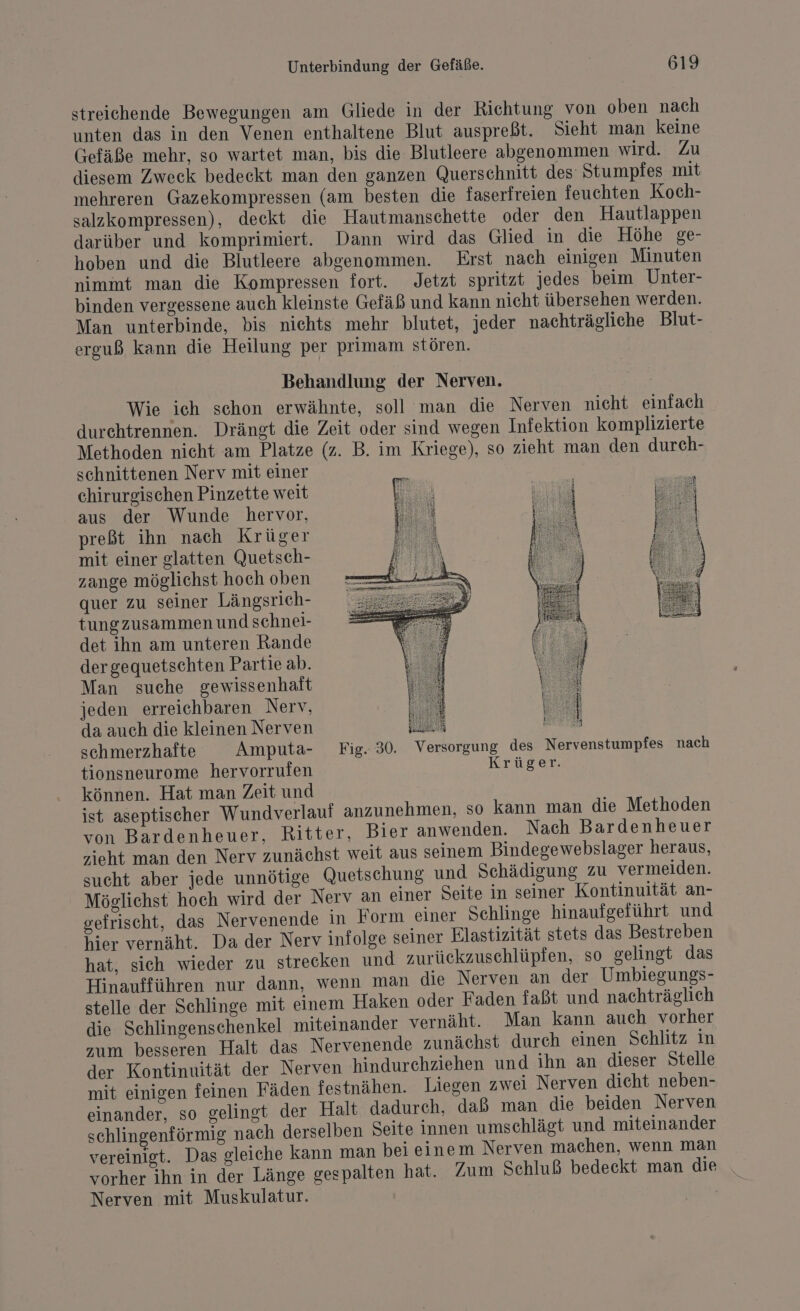 streichende Bewegungen am Gliede in der Richtung von oben nach unten das in den Venen enthaltene Blut auspreßt. Sieht man keine Gefäße mehr, so wartet man, bis die Blutleere abgenommen wird. Zu diesem Zweck bedeckt man den ganzen Querschnitt des’ Stumpfes mit mehreren Gazekompressen (am besten die faserfreien feuchten Koch- salzkompressen), deckt die Hautmanschette oder den Hautlappen darüber und komprimiert. Dann wird das Glied in die Höhe ge- hoben und die Blutleere abgenommen. Erst nach einigen Minuten nimmt man die Kompressen fort. Jetzt spritzt jedes beim Unter- binden vergessene auch kleinste Gefäß und kann nicht übersehen werden. Man unterbinde, bis nichts mehr blutet, jeder nachträgliche Blut- erguß kann die Heilung per primam stören. Behandlung der Nerven. Wie ich schon erwähnte, soll man die Nerven nicht einfach durehtrennen. Drängt die Zeit oder sind wegen Infektion komplizierte Methoden nicht am Platze (z. B. im Kriege), so zieht man den durch- schnittenen Nerv mit einer chirurgischen Pinzette weit aus der Wunde hervor, preßt ihn nach Krüger mit einer glatten Quetsch- zange möglichst hoch oben quer zu seiner Längsrich- tungzusammen und schnei- det ihn am unteren Rande dergequetschten Partie ab. Man suche gewissenhaft jeden erreichbaren Nerv, da auch die kleinen Nerven a | schmerzhafte Amputa- Fig. 30. Versorgung des Nervenstumpfes nach tionsneurome hervorrufen Krüger. können. Hat man Zeit und ist aseptischer Wundverlauf anzunehmen, so kann man die Methoden von Bardenheuer, Ritter, Bier anwenden. Nach Bardenheuer zieht man den Nerv zunächst weit aus seinem Bindegewebslager heraus, sucht aber jede unnötige Quetschung und Schädigung zu vermeiden. Möglichst hoch wird der Nerv an einer Seite in seiner Kontinuität an- gefrischt, das Nervenende in Form einer Schlinge hinaufgeführt und hier vernäht. Da der Nerv infolge seiner Blastizität stets das Bestreben hat, sich wieder zu strecken und zurückzuschlüpfen, so gelingt das Hinaufführen nur dann, wenn man die Nerven an der Umbiegungs- stelle der Sehlinge mit einem Haken oder Faden faßt und nachträglich die Schlingensehenkel miteinander vernäht. Man kann auch vorher zum besseren Halt das Nervenende zunächst durch einen Schlitz in der Kontinuität der Nerven hindurchziehen und ihn an dieser Stelle mit einigen feinen Fäden festnähen. Liegen zwei Nerven dicht neben- einander, so gelingt der Halt dadurch, daß man die beiden Nerven schlingenförmig nach derselben Seite innen umschlägt und miteinander vereinigt. Das gleiche kann man bei einem Nerven machen, wenn man | ; Nerven mit Muskulatur. IE