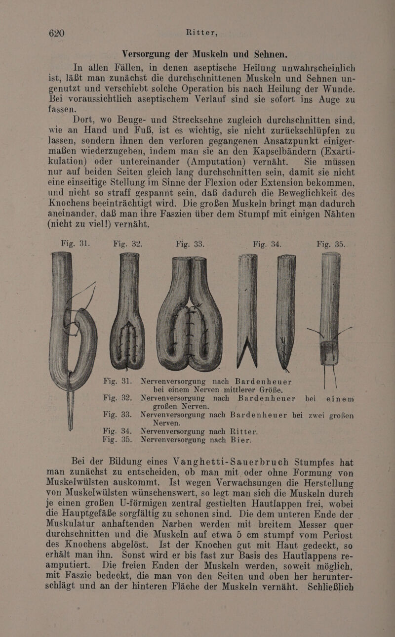 Versorgung der Muskeln und Sehnen. In allen Fällen, in denen aseptische Heilung unwahrscheinlich ist, läßt man zunächst die durchschnittenen Muskeln und Sehnen un- genutzt und verschiebt solche Operation bis nach Heilung der Wunde. Bei voraussichtlich aseptischem Verlauf sind sie sofort ins Auge zu fassen. Dort, wo Beuge- und Strecksehne zugleich durchschnitten sind, wie an Hand und Fuß, ist es wichtig, sie nicht zurückschlüpfen zu lassen, sondern ihnen den verloren gegangenen Ansatzpunkt einiger- maßen wiederzugeben, indem man sie an den Kapselbändern (Exarti- kulation) oder untereinander (Amputation) vernäht. Sie müssen nur auf beiden Seiten gleich lang durchschnitten sein, damit sie nicht eine einseitige Stellung im Sinne der Flexion oder Extension bekommen, und nicht so straff gespannt sein, daß dadurch die Beweglichkeit des Knochens beeinträchtigt wird. Die großen Muskeln bringt man dadurch aneinander, daß man ihre Faszien über dem Stumpf mit einigen Nähten (nicht zu viel!) vernäht. SL Fig. 31. Fig. 32. Fig. 33. Fig. 34. Fig. 35. Fig. 31. Nervenversorgung nach Bardenheuer \ bei einem Nerven mittlerer Größe. Fig. 32. Nervenversorgung nach Bardenheuer bei einem großen Nerven. Fig. 33. Nervenversorgung nach Bardenheuer bei zwei großen Nerven. Fig. 34. Nervenversorgung nach Ritter. Fig. 35. Nervenversorgung nach Bier. Bei der Bildung eines Vanghetti-Sauerbruch Stumpfes hat man zunächst zu entscheiden, ob man mit oder ohne Formung von Muskelwülsten auskommt. Ist wegen Verwachsungen die Herstellung von Muskelwülsten wünschenswert, so legt man sich die Muskeln durch je einen großen U-förmigen zentral gestielten Hautlappen frei, wobei die Hauptgefäße sorgfältig zu schonen sind. Die dem unteren Ende der Muskulatur anhaftenden Narben werden‘ mit breitem Messer quer durchschnitten und die Muskeln auf etwa 5 em stumpf vom Periost des Knochens abgelöst. Ist der Knochen gut mit Haut gedeckt, so erhält man ihn. Sonst wird er bis fast zur Basis des Hautlappens re- amputiert. Die freien Enden der Muskeln werden, soweit möglich, mit Faszie bedeckt, die man von den Seiten und oben her herunter- schlägt und an der hinteren Fläche der Muskeln vernäht. Schließlich