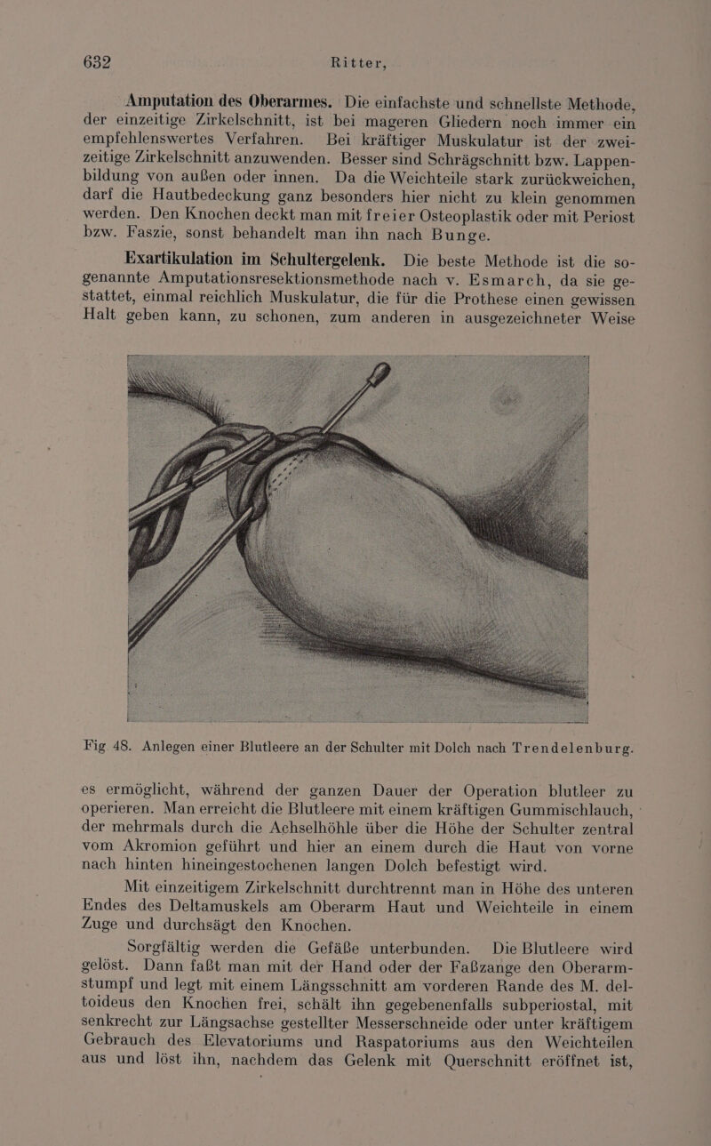 Amputation des Oberarmes. Die einfachste und schnellste Methode, der einzeitige Zirkelschnitt, ist bei mageren Gliedern noch immer ein empfehlenswertes Verfahren. Bei kräftiger Muskulatur ist der zwei- zeitige Zirkelschnitt anzuwenden. Besser sind Schrägschnitt bzw. Lappen- bildung von außen oder innen. Da die Weichteile stark zurückweichen, darf die Hautbedeckung ganz besonders hier nicht zu klein genommen werden. Den Knochen deckt man mit freier Osteoplastik oder mit Periost bzw. Faszie, sonst behandelt man ihn nach Bunge. Exartikulation im Schultergelenk. Die beste Methode ist die so- genannte Amputationsresektionsmethode nach v. Esmarch, da sie ge- stattet, einmal reichlich Muskulatur, die für die Prothese einen gewissen Halt geben kann, zu schonen, zum anderen in ausgezeichneter Weise Fig. 48. Anlegen einer Blutleere an der Schulter mit Dolch nach Trendelenburg. es ermöglicht, während der ganzen Dauer der Operation blutleer zu operieren. Man erreicht die Blutleere mit einem kräftigen Gummischlauch, der mehrmals durch die Achselhöhle über die Höhe der Schulter zentral vom Akromion geführt und hier an einem durch die Haut von vorne nach hinten hineingestochenen langen Dolch befestigt wird. Mit einzeitigem Zirkelschnitt durchtrennt man in Höhe des unteren Endes des Deltamuskels am Oberarm Haut und Weichteile in einem Zuge und durchsägt den Knochen. Sorgfältig werden die Gefäße unterbunden. Die Blutleere wird gelöst. Dann faßt man mit der Hand oder der Faßzange den Oberarm- stumpf und legt mit einem Längsschnitt am vorderen Rande des M. del- toideus den Knochen frei, schält ihn gegebenenfalls subperiostal, mit senkrecht zur Längsachse gestellter Messerschneide oder unter kräftigem Gebrauch des Elevatoriums und Raspatoriums aus den Weichteilen aus und löst ihn, nachdem das Gelenk mit Querschnitt eröffnet ist,