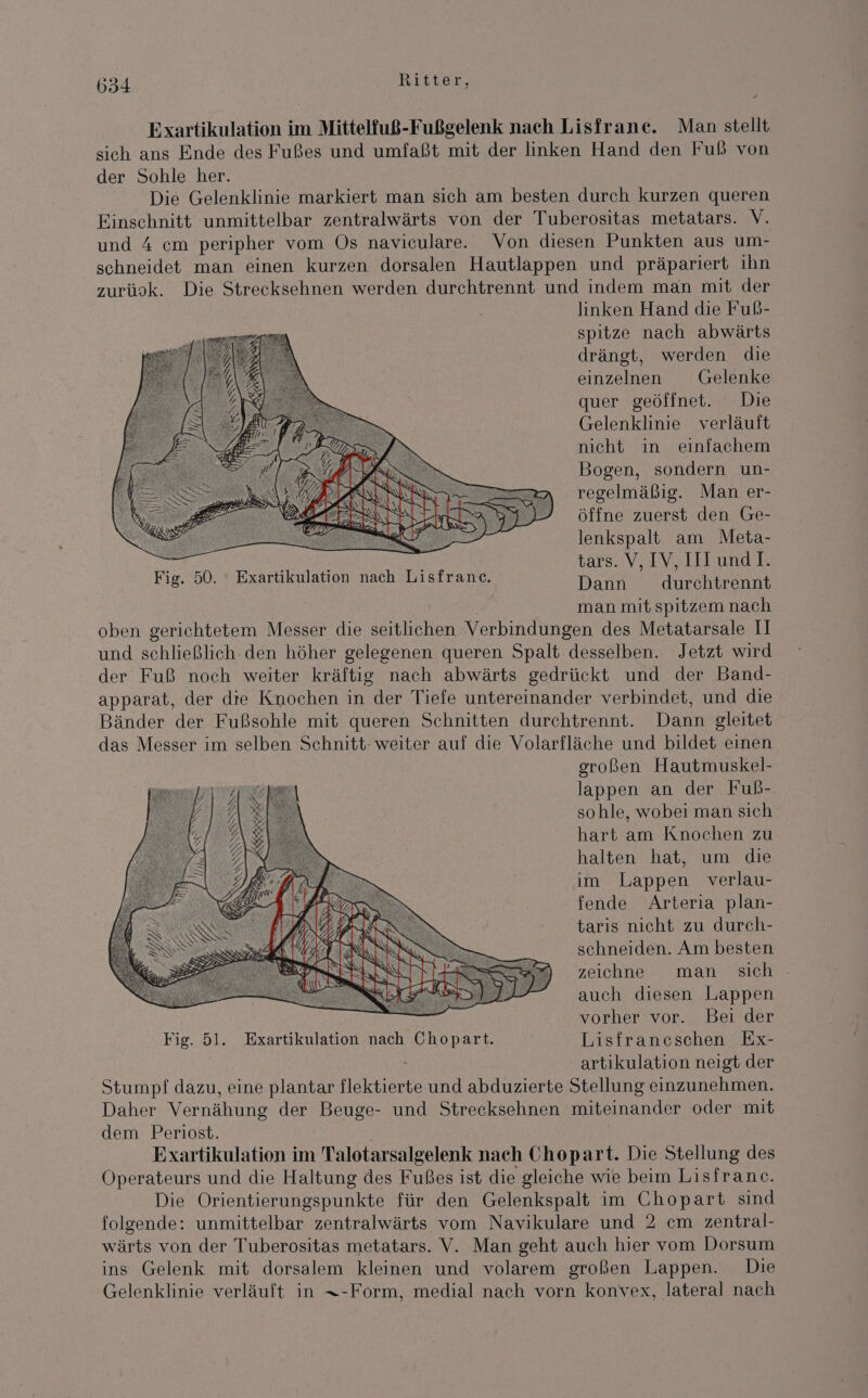 + Exartikulation im Mittelfuß-Fußgelenk nach Lisfrane. Man stellt sich ans Ende des Fußes und umfaßt mit der linken Hand den Fuß von der Sohle her. Die Gelenklinie markiert man sich am besten durch kurzen queren Einschnitt unmittelbar zentralwärts von der Tuberositas metatars. V. und 4 cm peripher vom Os naviculare. Von diesen Punkten aus um- schneidet man einen kurzen dorsalen Hautlappen und präpariert ihn zurüok. Die Strecksehnen werden durchtrennt und indem man mit der linken Hand die Fub- spitze nach abwärts drängt, werden die einzelnen Gelenke quer geöffnet. Die Gelenklinie verläuft nicht in einfachem Bogen, sondern un- regelmäßig. Man er- öffne zuerst den Ge- lenkspalt am Meta- tars. V, IV, III undl. Dann durchtrennt man mit spitzem nach oben gerichtetem Messer die seitlichen Verbindungen des Metatarsale II und schließlich. den höher gelegenen queren Spalt desselben. Jetzt wird der Fuß noch weiter kräftig nach abwärts gedrückt und der Band- apparat, der die Knochen in der Tiefe untereinander verbindet, und die Bänder der Fußsohle mit queren Schnitten durchtrennt. Dann gleitet das Messer im selben Schnitt- weiter auf die Volarfläche und bildet einen großen Hautmuskel- lappen an der Fub- sohle, wobei man sich hart am Knochen zu halten hat, um die im Lappen verlau- fende Arteria plan- tarıs nicht zu durch- schneiden. Am besten zeichne man sich auch diesen Lappen vorher vor. Bei der Fig. 5l. Exartikulation nach a Lisfraneschen Ex- artikulation neigt der Stumpf dazu, eine plantar tlektierte und abduzierte Stellung einzunehmen. Daher Vernähung der Beuge- und Streeksehnen miteinander oder mit dem Periost. Exartikulation im Talotarsalgelenk nach Chopart. Die Stellung des Operateurs und die Haltung des Fußes ist die gleiche wie beim Lisfranc. Die Orientierungspunkte für den Gelenkspalt im Chopart sind folgende: unmittelbar zentralwärts vom Navikulare und 2 cm zentral- wärts von der Tuberositas metatars. V. Man geht auch hier vom Dorsum ins Gelenk mit dorsalem kleinen und volarem großen Lappen. Die Gelenklinie verläuft in x-Form, medial nach vorn konvex, lateral nach Fig. 50. ° Exartikulation nach Lisfranc.
