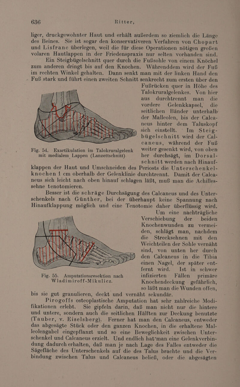 liger, druckgewohnter Haut und erhält außerdem so ziemlich die Länge des Beines. Sie ist sogar den konservativeren Verfahren von Chopart und Lisfranc überlegen, weil die für diese Operationen nötigen großen volaren Hautlappen in der Friedenspraxis nur selten vorhanden sind. Ein Steigbügelschnitt quer durch die Fußsohle von einem Knöchel zum anderen dringt bis auf den Knochen. Währenddem wird der Fuß im rechten Winkel gehalten. Dann senkt man mit der linken Hand den Fuß stark und führt einen zweiten Schnitt senkrecht zum ersten über den Fußrücken quer in Höhe des Talokruralgelenkes. Von hier aus durchtrennt man die vordere Gelenkkapsel, die seitlichen Bänder unterhalb: der Malleolen, bis der Calca- neus hinter dem Taluskopf sich einstellt. ‘ Im Steig- - bügelschnitt wird der Cal- caneus, während der Fuß Fig. 54. Exartikulation im Talokruralgelenk Weiter gesenkt wird, von oben mit medialem Lappen (Lanzettschnitt). her durchsägt, im Dorsal- ’ . schnitt werden nach Hinauf- klappen der Haut und Umschneiden des Periosts die Unterschenkel- knochen 1 cm oberhalb der Gelenklinie durchtrennt. Damit der Calca- neus sich leicht nach oben hinauf schlagen läßt, muß man die Achilles- sehne tenotomieren. Besser ist die schräge Durchsägung des Calcaneus und des Unter- schenkels nach Günther, bei der überhaupt keine Spannung nach Hinaufklappung möglich und eine Tenotomie daher überflüssig wird. Um eine nachträgliche Verschiebung der ° beiden Knochenwunden zu vermei- den, schlägt man, nachdem die Strecksehnen mit den Weichteilen der Sohle vernäht sind, von unten her durch den Calcaneus in die Tibia einen Nagel, der später ent- fernt wird. Ist in schwer Fig. 55. Amputationsresektion nach infizierten Fällen primäre Wladimiroff-Mikulicz. Knochendeckung gefährlich, so läßt man die Wunden offen, bis sie gut granulieren, deckt und vernäht sekundär. Pirogoffs osteoplastische Amputation hat sehr zahlreiche Modi- fikationen erlebt. Sie gipfeln darin, daß man nicht nur die hintere und untere, sondern auch die seitlichen Hälften zur Deckung benutzte (Tauber, v. Eiselsberg). Ferner hat man den Calcaneus, entweder das abgesägte Stück oder den ganzen Knochen, in die erhaltene Mal- leolengabel eingepflanzt und so eine Beweglichkeit zwischen Unter- schenkel und Calcaneus erzielt. Und endlich hat'man eine Gelenkverbin- dung dadurch erhalten, daß man je nach Lage des Falles entweder die Sägefläche des Unterschenkels auf die des Talus brachte und die Ver- bindung zwischen Talus und Calcaneus beließ, oder die abgesägten SON