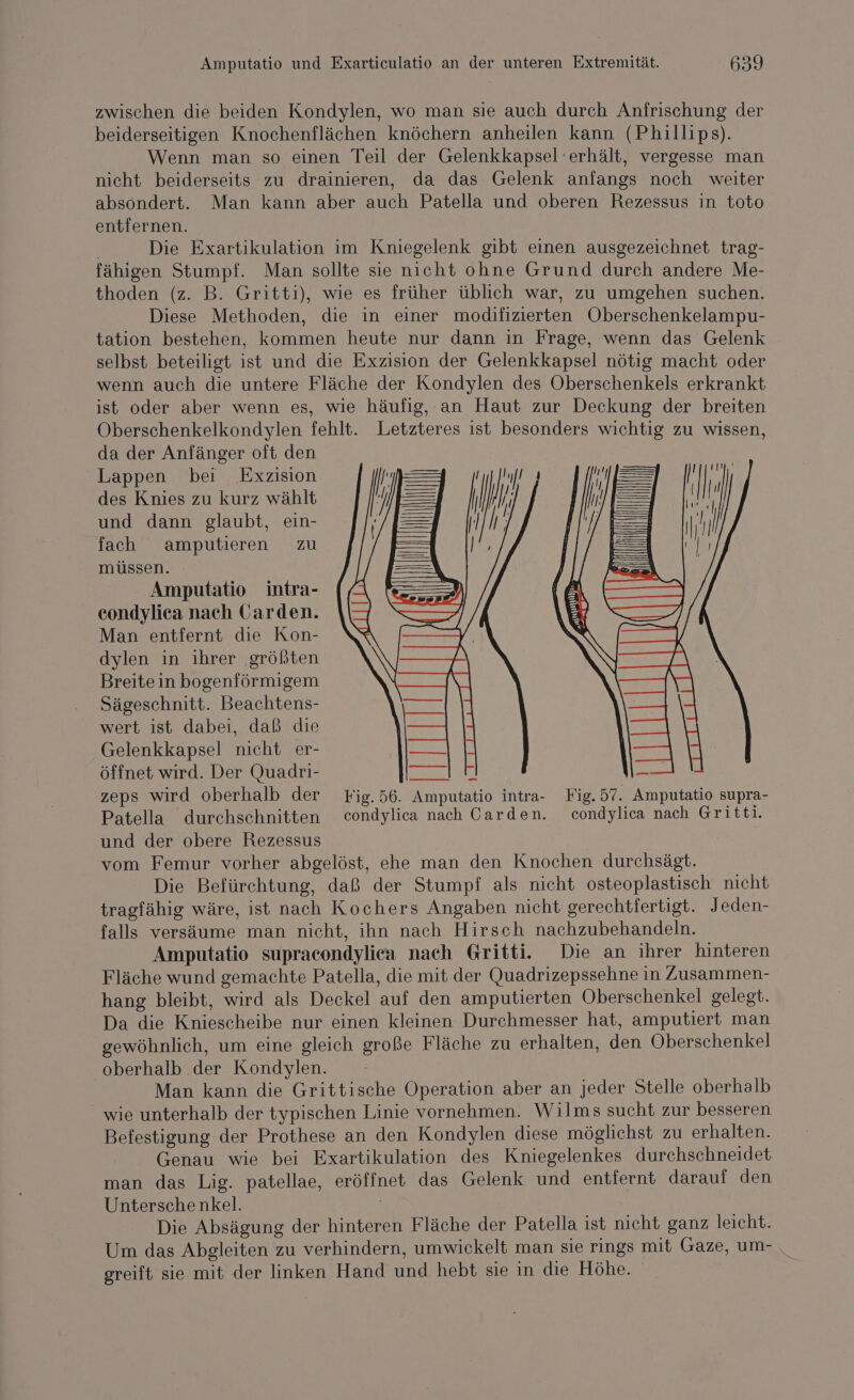 zwischen die beiden Kondylen, wo man sie auch durch Anfrischung der beiderseitigen Knochenflächen knöchern anheilen kann (Phillips). Wenn man so einen Teil der Gelenkkapsel erhält, vergesse man nicht beiderseits zu drainieren, da das Gelenk anfangs noch weiter absondert. Man kann aber auch Patella und oberen Rezessus in toto entfernen. Die Exartikulation im Kniegelenk gibt einen ausgezeichnet trag- fähigen Stumpf. Man sollte sie nicht ohne Grund durch andere Me- thoden (z. B. Gritti), wie es früher üblich war, zu umgehen suchen. Diese Methoden, die in einer modifizierten Oberschenkelampu- tation bestehen, kommen heute nur dann in Frage, wenn das Gelenk selbst beteiligt ist und die Exzision der Gelenkkapsel nötig macht oder wenn auch die untere Fläche der Kondylen des Oberschenkels erkrankt ist oder aber wenn es, wie häufig, an Haut zur Deckung der breiten Oberschenkelkondylen fehlt. Letzteres ist besonders wichtig zu wissen, da der Anfänger oft den Lappen bei Exzision des Knies zu kurz wählt und dann glaubt, ein- fach amputieren zu müssen. Amputatio intra- condylica nach Garden. Man entfernt die Kon- dylen in ihrer größten Breite in bogenförmigem Sägeschnitt. Beachtens- wert ist dabei, daß die Gelenkkapsel nicht er- öffnet wird. Der Quadri- wen zeps wird oberhalb der Fig.56. Amputatio intra- Fig. 57. Amputatio supra- Patella durchschnitten condylica nach Carden. condylica nach Gritti. und der obere Rezessus vom Femur vorher abgelöst, ehe man den Knochen durchsägt. Die Befürchtung, daß der Stumpf als nicht osteoplastisch nicht tragfähig wäre, ist nach Kochers Angaben nicht gerechtfertigt. Jeden- falls versäume man nicht, ihn nach Hirsch nachzubehandeln. Amputatio supracondylica nach Gritti. Die an ihrer hinteren Fläche wund gemachte Patella, die mit der Quadrizepssehne in Zusammen- hang bleibt, wird als Deckel auf den amputierten Oberschenkel gelegt. Da die Kniescheibe nur einen kleinen Durchmesser hat, amputiert man gewöhnlich, um eine gleich große Fläche zu erhalten, den Oberschenkel oberhalb der Kondylen. Man kann die Grittische Operation aber an jeder Stelle oberhalb _ wie unterhalb der typischen Linie vornehmen. Wilms sucht zur besseren Befestigung der Prothese an den Kondylen diese möglichst zu erhalten. Genau wie bei Exartikulation des Kniegelenkes durchschneidet man das Lig. patellae, eröffnet das Gelenk und entfernt darauf den Unterschenkel. | Die Absägung der hinteren Fläche der Patella ist nicht ganz leicht. Um das Abgleiten zu verhindern, umwickelt man sie rings mit Gaze, um- \ greift sie mit der linken Hand und hebt sie in die Höhe. INN | SL Ta we | IF Bi 2