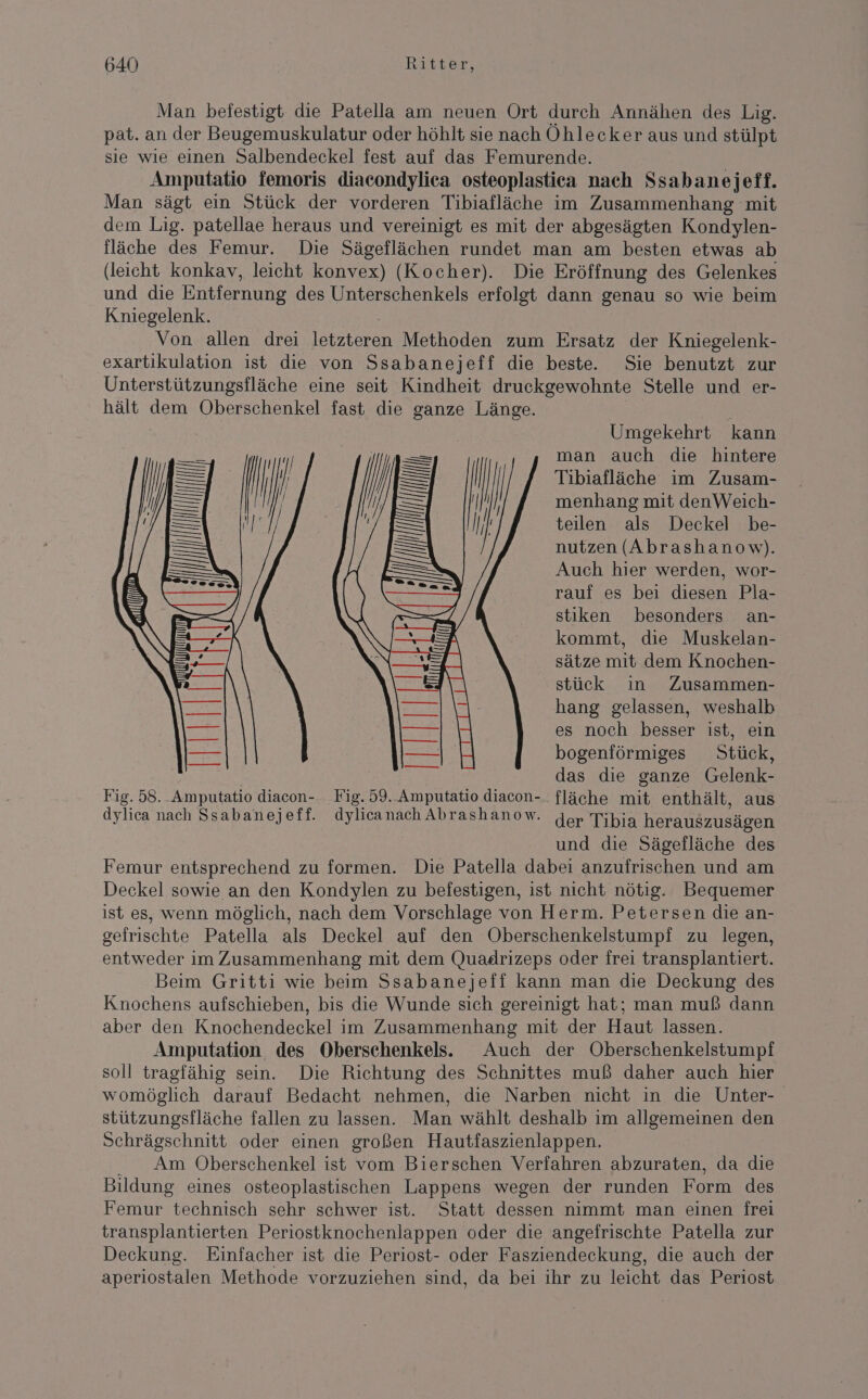 Man befestigt die Patella am neuen Ort durch Annähen des Lig. pat. an der Beugemuskulatur oder höhlt sie nach Öhlecker aus und stülpt sie wie einen Salbendeckel fest auf das Femurende. | Amputatio femoris diacondyliea osteoplastica nach Ssabanejeff. Man sägt ein Stück der vorderen Tibiafläche im Zusammenhang mit dem Lig. patellae heraus und vereinigt es mit der abgesägten Kondylen- fläche des Femur. Die Sägeflächen rundet man am besten etwas ab (leicht konkav, leicht konvex) (Kocher). Die Eröffnung des Gelenkes und die Entfernung des Unterschenkels erfolgt dann genau so wie beim Kniegelenk. Von allen drei en Methoden zum Ersatz der Kniegelenk- exartikulation ist die von Ssabanejeff die beste. Sie benutzt zur Unterstützungsfläche eine seit Kindheit druckgewohnte Stelle und er- hält dem Oberschenkel fast die ganze Länge. | Umgekehrt kann man auch die hintere Tibiafläche im Zusam- menhang mit denWeich- teilen als Deckel be- nutzen (Abrashanow). Auch hier werden, wor- rauf es bei diesen Pla- stiken besonders an- kommt, die Muskelan- sätze mit dem Knochen- stück in Zusammen- hang gelassen, weshalb es noch besser ist, ein bogenförmiges Stück, das die ganze Gelenk- Fig. 58._Amputatio diacon-. Fig. 59. Amputatio diacon-. fläche mit enthält, aus dylica nach Ssabanejeff. dylicanach Abrashanow. Jer Tibia herauszusägen und die Sägefläche des Femur entsprechend zu formen. Die Patella dabei anzufrischen und am Deckel sowie an den Kondylen zu befestigen, ist nicht nötig. Bequemer ist es, wenn möglich, nach dem Vorschlage von Herm. Petersen die an- gefrischte Patella als Deckel auf den Oberschenkelstumpf zu legen, entweder im Zusammenhang mit dem Quadrizeps oder frei transplantiert. Beim Gritti wie beim Ssabanejeff kann man die Deckung des Knochens aufschieben, bis die Wunde sich gereinigt hat; man muß dann aber den Knochendeckel im Zusammenhang mit der Haut lassen. Amputation des Oberschenkels. Auch der Oberschenkelstumpf soll tragfähig sein. Die Richtung des Schnittes muß daher auch hier womöglich darauf Bedacht nehmen, die Narben nicht in die Unter- stützungsfläche fallen zu lassen. Man wählt deshalb im allgemeinen den Schrägschnitt oder einen großen Hautfaszienlappen. Am Oberschenkel ist vom Bierschen Verfahren abzuraten, da die Bildung eines osteoplastischen Lappens wegen der runden Form des Femur technisch sehr schwer ist. Statt dessen nimmt man einen frei transplantierten Periostknochenlappen oder die angefrischte Patella zur Deckung. Einfacher ist die Periost- oder Fasziendeckung, die auch der aperiostalen Methode vorzuziehen sind, da bei ihr zu leicht das Periost