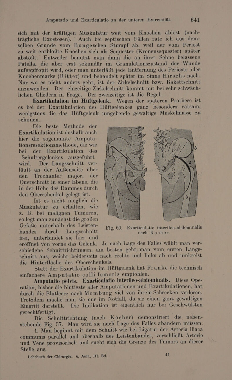 sich mit der kräftigen Muskulatur weit vom Knochen ablöst (nach- trägliche Exostosen). Auch bei septischen Fällen rate ich aus dem- selben Grunde vom Bungeschen Stumpf ab, weil der vom Periost zu weit entblößte Knochen sich als Sequester (Kronensequester) später abstößt. Entweder benutzt man dann die an ihrer Sehne belassene Patella, die aber erst sekundär im Granulationszustand der Wunde aufgepfropft wird, oder man unterläßt jede Entfernung des Periosts oder Knochenmarks (Ritter) und behandelt später im Sinne Hirschs nach. Nur wo es nicht anders geht, ist der Zirkelschnitt bzw. Rakettschnitt anzuwenden. Der einzeitige Zirkelschnitt kommt nur bei sehr schwäch- lichen Gliedern in Frage. Der zweizeitige ist die Regel. Exartikulation im Hüftgelenk. Wegen der späteren Prothese ist es bei der Exartikulation des Hüftgelenkes ganz besonders ratsam, wenigstens die das Hüftgelenk umgebende gewaltige Muskelmasse zu schonen. ‘Die beste Methode der Exartikulation ist deshalb auch hier die sogenannte Amputa- tionsresektionsmethode, die wie bei der Exartikulation des Schultergelenkes ausgeführt wird. Der Längsschnitt ver- läuft an der Außenseite über den Trochanter major, der Querschnitt in einer Ebene, die in der Höhe des Dammes durch den Oberschenkel gelegt ist. Ist es nicht möglich die Muskulatur zu erhalten, wie z. B. bei malignen Tumoren, so legt man zunächst die großen Gefäße unterhalb des Leisten- bandes durch Längsschnitt frei, unterbindet sie hier und eröffnet von vorne das Gelenk. Je nach Lage des Falles wählt man ver- schiedene Schnittrichtungen, am besten geht: man vom ersten Längs- schnitt aus, weicht beiderseits nach rechts und links ab und umkreist die Hinterfläche des Oberschenkels. | | Statt der Exartikulation im Hüftgelenk hat Franke die technisch einfachere Amputatio colli femoris empfohlen. Amputatio pelvis. Exarticulatio interileo-abdomimalis. Diese Ope- ration, bisher die blutigste aller Amputationen und Exartikulationen, hat durch die Blutleere nach Momburg viel von ihrem Schrecken verloren. Trotzdem mache man sie nur im Notfall, da sie einen ganz gewaltigen Eingriff darstellt. Die Indikation ist eigentlich nur bei Geschwülsten gerechtfertigt. / Die Schnittrichtung (nach Kocher) demonstriert die neben- stehende Fig. 57. Man wird sie nach Lage des Falles abändern müssen. 1. Man beginnt mit dem Schnitt wie bei Ligatur der Arteria iliaca communis parallel und oberhalb des Leistenbandes, verschließt Arterie und Vene provisorisch und sucht sich die Grenze des Tumors an dieser Stelle aus. Lehrbuch der Chirurgie. 6. Aufl., III. Bd. 41 Fig. 60. Exarticulatio interileo-abdominalis nach Kocher.